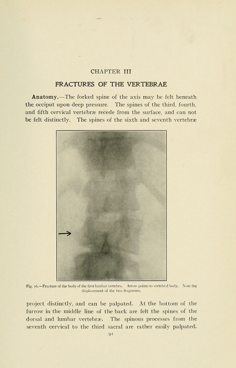 CHAPTER III FRACTURES OF THE VERTEBRAE Anatomy.—The forked spine of the axis may be felt beneath the occiput upon deep pressure. The spines of the third, fourth, and fifth cervical vertebrae recede from the surface, and can not be felt distinctly. The spines of the sixth and seventh vertebrae Fig. 76.—Fracture of the body of the first lumbar vertebra. Arnnv ijoints to vertebral body. Note the displacement of the two fragments. project distinctly, and can be palpated. At the bottom of the furrow in the middle line of the back are felt the spines of the dorsal and lumbar vertebrae. The spinous processes from the seventh cervical to the third sacral are rather easily palpated.