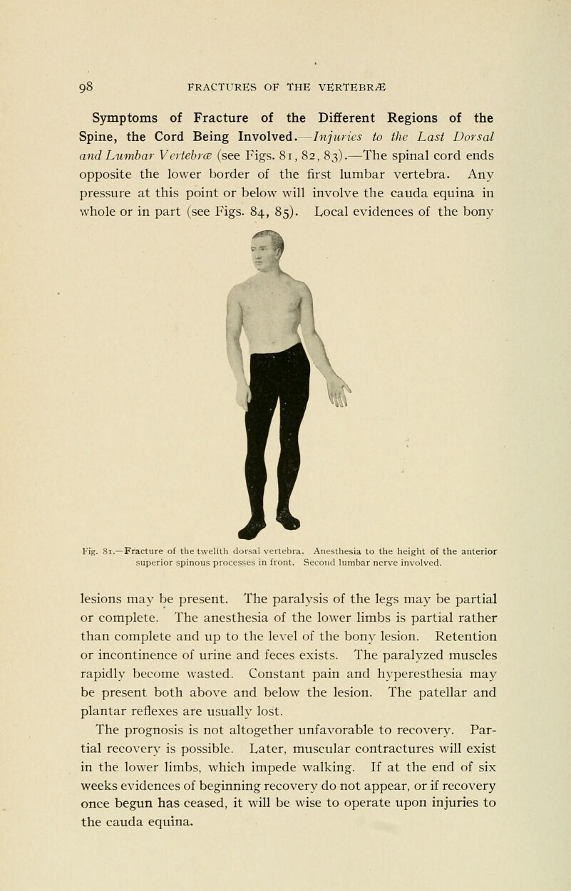 Symptoms of Fracture of the Different Regions of the Spine, the Cord Being Involved.—Injuries to the Last Dorsal and Lumbar Vertebra (see Figs. 8i, 82, 83).—The spinal cord ends opposite the lower border of the first lumbar vertebra. Any pressure at this point or below will involve the cauda equina in whole or in part (see Figs. 84, 85). Local evidences of the bony Fig. 81.—Fracture of the twelfth dorsal vertebra. Anesthesia to the height of the anterior superior spinous processes in front. Second lumbar nerve involved. lesions may be present. The paralysis of the legs may be partial or complete. The anesthesia of the lower limbs is partial rather than complete and up to the level of the bony lesion. Retention or incontinence of urine and feces exists. The paralyzed muscles rapidly become wasted. Constant pain and hyperesthesia may be present both above and below the lesion. The patellar and plantar reflexes are usually lost. The prognosis is not altogether unfavorable to recovery. Par- tial recovery is possible. Later, muscular contractures will exist in the lower limbs, which impede walking. If at the end of six weeks evidences of beginning recovery do not appear, or if recovery once begun has ceased, it will be wise to operate upon injuries to the Cauda equina.