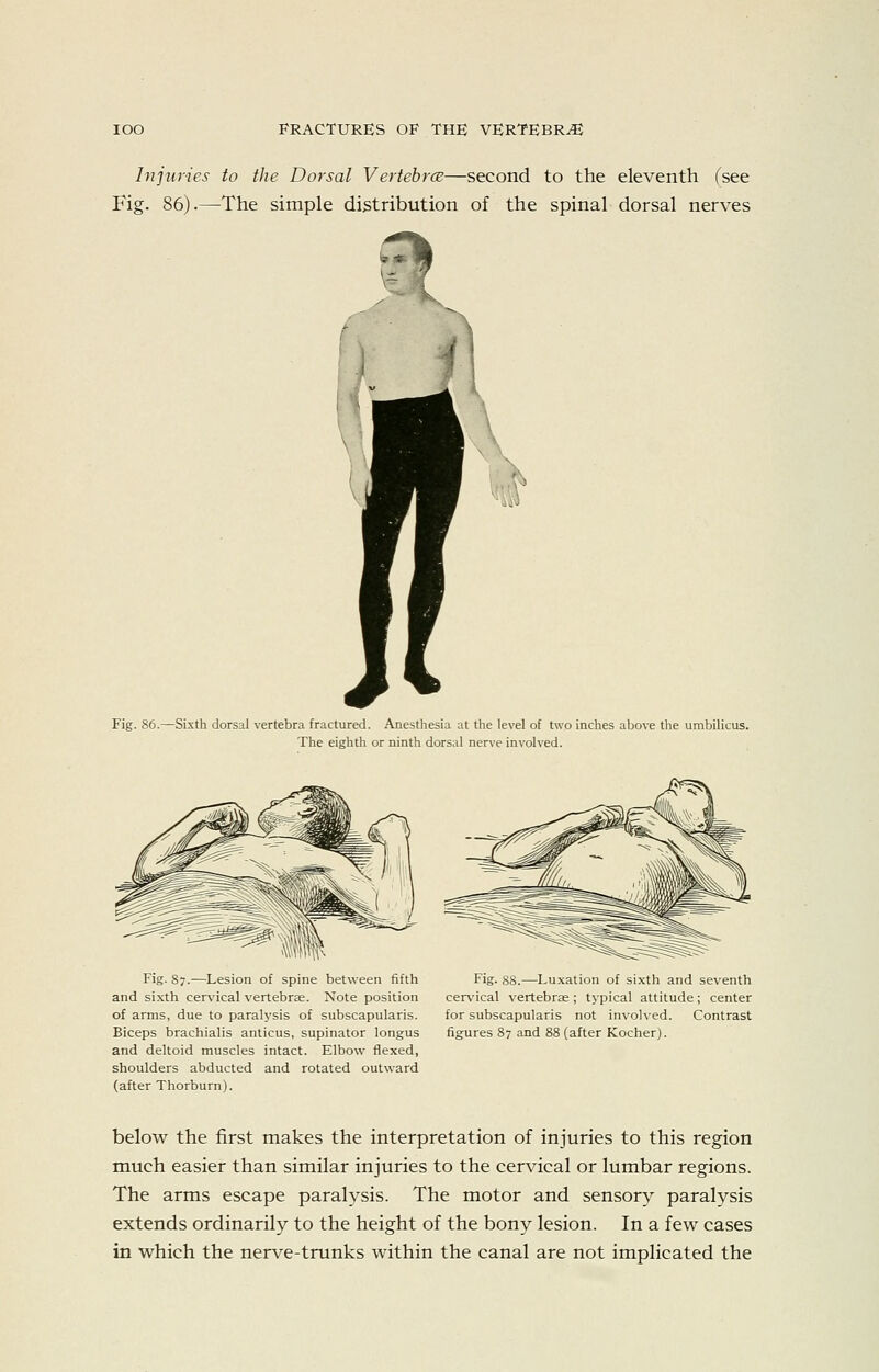 Injuries to the Dorsal Vertehrce—second to the eleventh (see Fig. 86).—The simple distribution of the spinal dorsal nerves ?l Fig. 86. -Si.xth dorsal vertebra fractured. Anesthesia at the level of two inches above the umbilicus. The eighth or ninth dorsal nerve involved. Fig. 87.—Lesion of spine between fifth and sixth cervical vertebrae. Note position of arms, due to paralysis of subscapularis. Biceps brachialis anticus, supinator longus and deltoid muscles intact. Elbow flexed, shoulders abducted and rotated outward (after Thorburn). Fig. 88.—Luxation of sixth and seventh cervical vertebras; typical attitude; center for subscapularis not involved. Contrast figures 87 and 88 (after Kocher). below the first makes the interpretation of injuries to this region much easier than similar injuries to the cervical or lumbar regions. The arms escape paralysis. The motor and sensory paralysis extends ordinarily to the height of the bony lesion. In a few cases in which the ner\^e-trunks within the canal are not implicated the