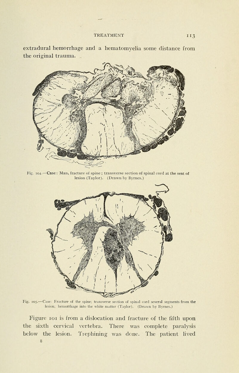 extradural hemorrhage and a hematomyelia some distance from the original trauma. _ Fig. 104.—Case : Man, fracture of spine ; transverse section of spinal cord at the seat of lesion (Taylor). (Drawn by Byrnes.) Fig. 105.—Case: Fracture of the spine; transverse section of spinal cord several segments from the lesion; hemorrhage into the white matter (Taylor). (Drawn by Byrnes.) Figure loi is from a dislocation and fracture of the fifth upon the sixth cervical vertebra. There was complete paralysis below the lesion. Trephining was done. The patient lived 8