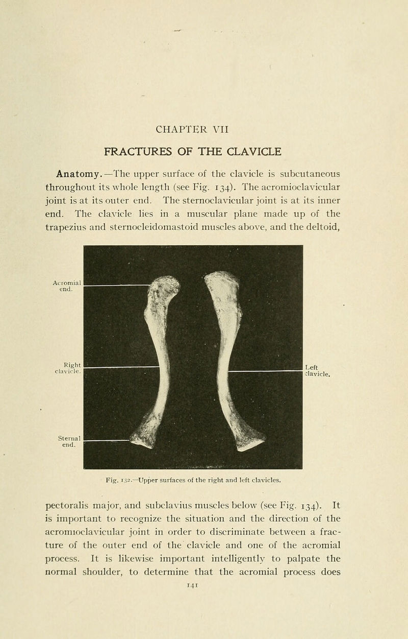 CHAPTER VII FRACTURES OF THE CLAVICLE Anatomy.—The upper surface of the clavicle is subcutaneous throughout its whole length (see Fig. 134). The acromioclavicular joint is at its outer end. The sternoclavicular joint is at its inner end. The clavicle lies in a muscular plane made up of the trapezius and sternocleidomastoid muscles above, and the deltoid, Acromial end. ■ Right clavicle. ^^^H ^1 ■jjHH ^^^^^K ^^^^H ^H ^^^^^^Hr ^^^1 ^H^^H ^^^^^BP'' j^^H ^^B.^1 ^^^^^1 Sternal ^I^^^B^M^^^^l ^^^^^^K \^H P^^^l end. ^B^B ^B Left olavicle Fig. 132.—^Upper surfaces of the right and left clavicles. pectoralis major, and subclavius muscles below (see Fig. 134). It is important to recognize the situation and the direction of the acromioclavicular joint in order to discriminate between a frac- ture of the outer end of the clavicle and one of the acromial process. It is likewise important intelligently to palpate the normal shoulder, to determine that the acromial process does