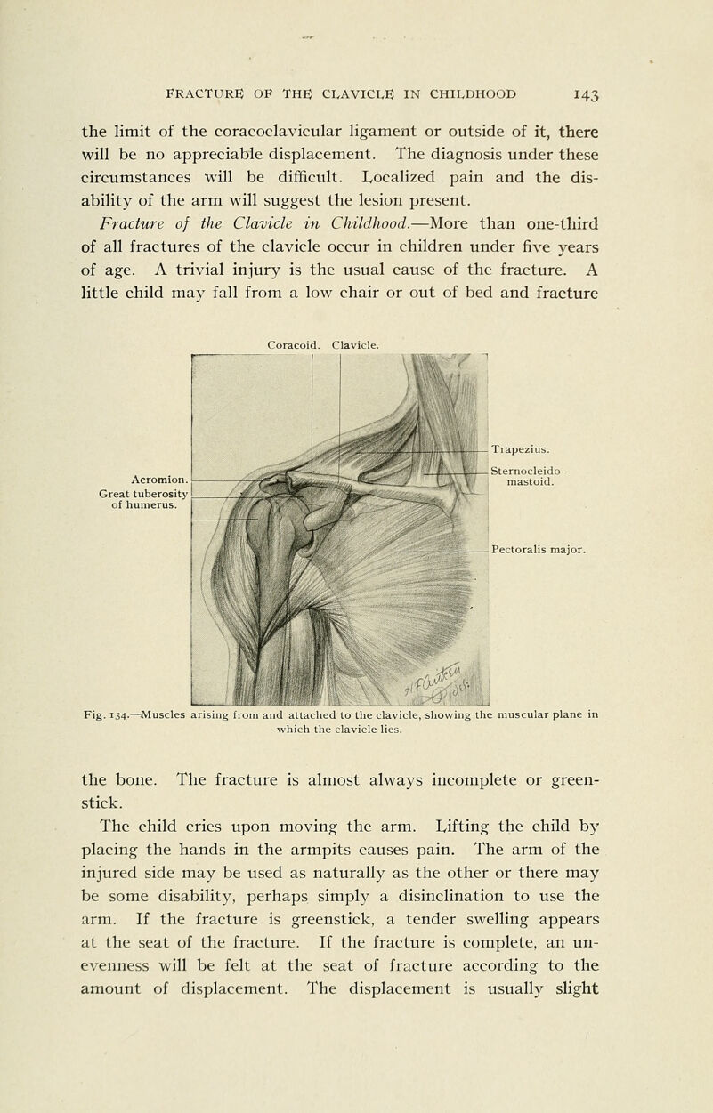 the limit of the coracoclavicular ligament or outside of it, there will be no appreciable displacement. The diagnosis under these circumstances will be difficult. Localized pain and the dis- ability of the arm will suggest the lesion present. Fracture of the Clavicle in Childhood.—More than one-third of all fractures of the clavicle occur in children under five years of age. A trivial injury is the usual cause of the fracture. A little child may fall from a low chair or out of bed and fracture Coracoid. Clavicle. Acromion. Great tuberosity -Trapezius. -Sternocleido- mastoid. Pectoralis major. Fig. 134.—Muscles arising iiuin and allachcd to the clavicle, showing the muscular plane in which the clavicle lies. the bone. The fracture is almost always incomplete or green- stick. The child cries upon moving the arm. Tifting the child by placing the hands in the armpits causes pain. The arm of the injured side may be used as naturally as the other or there may be some disability, perhaps simply a disinclination to use the arm. If the fracture is greenstick, a tender swelling appears at the seat of the fracture. If the fracture is complete, an un- evenness will be felt at the seat of fracture according to the amount of displacement. The displacement is usually slight