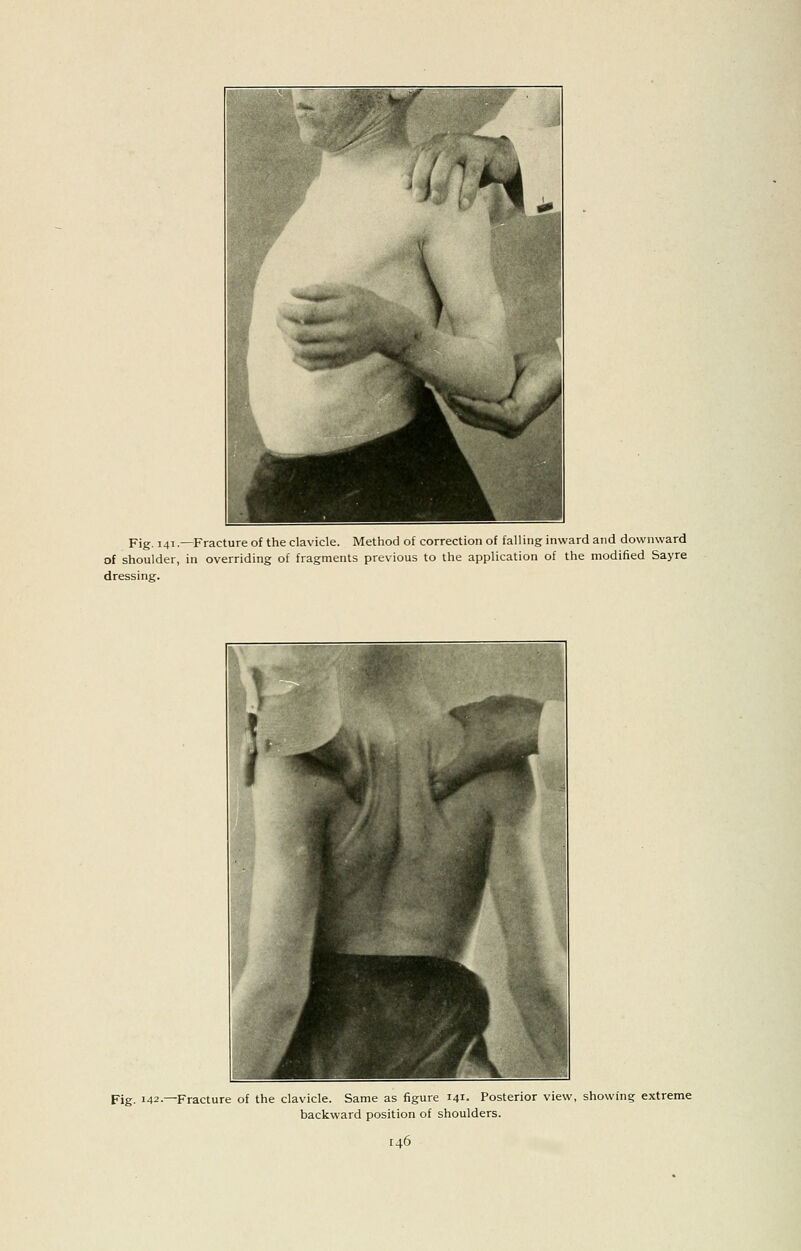 Fig. 141.—Fracture of the clavicle. Method of correction of falling inward and downward of shoulder, in overriding of fragments previous to the application of the modified Sayre dressing. Fig. 142.—Fracture of the clavicle. Same as figure 141. Posterior view, showing extreme backward position of shoulders.