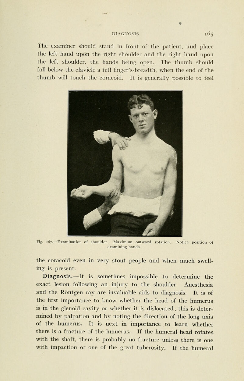 The examiner should stand in front of the patient, and place the left hand upon the right shoulder and the right hand upon the left shoulder, the hands being open. The thumb should fall below the clavicle a full finger's-breadth, when the end of the thumb will touch the coracoid. It is generally possible to feel Fig. 167.—Examination of slioulder. Maximum outward rotation. examining hands. Notice position of the coracoid even in very stout people and when much swell- ing is present. Diagnosis.—It is sometimes impossible to determine the exact lesion following an injury to the shoulder. Anesthesia and the Rontgen ray are invaluable aids to diagnosis. It is of the first importance to know whether the head of the humerus is in the glenoid cavity or whether it is dislocated; this is deter- mined by palpation and by noting the direction of the long axis of the humerus. It is next in importance to learn whether there is a fracture of the humerus. If the humeral head rotates with the shaft, there is probably no fracture unless there is one with impaction or one of the great tuberosity. If the humeral