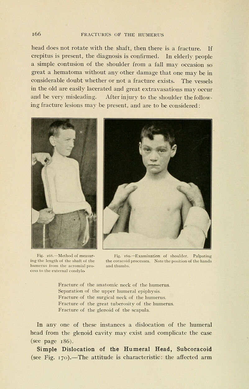 head does not rotate with the shaft, then there is a fracture. If crepitus is present, the diagnosis is confirmed. In elderly people a simple contusion of the shoulder from a fall may occasion so great a hematoma without any other damage that one may be in considerable doubt whether or not a fracture exists. The vessels in the old are easily lacerated and great extravasations may occur and be very misleading. After injury to the shoulder the follow- ing fracture lesions may be present, and are to be considered: Fig. i6S.—Method of measur- ing the length of the shaft of the humerus from the acromial pro- cess to the external condyle. Fig. 169.—Examination of shoulder. Palpating the coracoid processes. Note the position of the hands and thumbs. Fracture of the anatomic neck of the humerus. Separation of the upper humeral epiphysis. Fracture of the surgical neck of the humerus. Fracture of the great tuberosity of the humerus. Fracture of the glenoid of the scapula. In any one of these instances a dislocation of the humeral head from the glenoid cavity may exist and complicate the case (see page 186). Simple Dislocation of the Humeral Head, Subcoracoid (see Fig. 170).—The attitude is characteristic: the affected arm