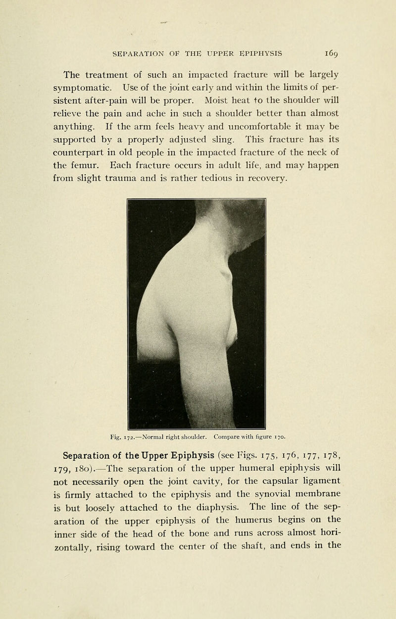 The treatment of such an impacted fracture will be largely symptomatic. Use of the joint early and within the limits of per- sistent after-pain will be proper. Moist heat to the shoulder will relieve the pain and ache in such a shoulder better than almost anything. If the arm feels heavy and uncomfortable it may be supported by a properly adjusted sling. This fracture has its counterpart in old people in the impacted fracture of the neck of the femur. Each fracture occurs in adult life, and may happen from slight trauma and is rather tedious in recovery. Fig. 172.—Normal right shoulder. Compare with figure 170. Separation of the Upper Epiphysis (see Figs. 175, 176, 177, 178, 179, 180).—The separation of the upper humeral epiphysis will not necessarily open the joint cavity, for the capsular ligament is firmly attached to the epiphysis and the synovial membrane is but loosely attached to the diaphysis. The line of the sep- aration of the upper epiphysis of the humerus begins on the inner side of the head of the bone and runs across almost hori- zontally, rising toward the center of the shaft, and ends in the