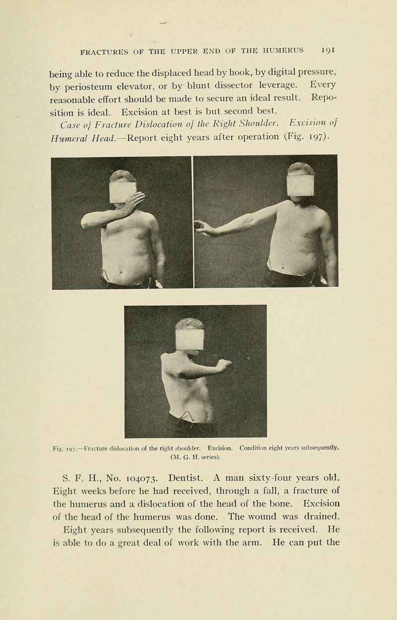 being able to reduce the displaced head by hook, by digital pressure, by periosteum elevator, or by blunt dissector leverage. Every reasonable effort should be made to secure an ideal result. Repo- sition is ideal. Excision at best is but second best. Case of Fracture Dislocation of the Right Shoulder. Excision of Humeral Head.—Report eight years after operation (Fig. 197). Fig. 197.—Fracture dislocation of the right shoulder. Excision. Condition eight years subsequently. (M. G. H. series). vS. F. H., No. 104073. Dentist. A man sixty-four years old. Eight weeks before he had received, through a fall, a fracture of the humerus and a dislocation of the head of the bone. Excision of the head of the humerus was done. The wound was drained. Eight years subsequently the following report is received. He is able to do a great deal of work with the arm. He can put the