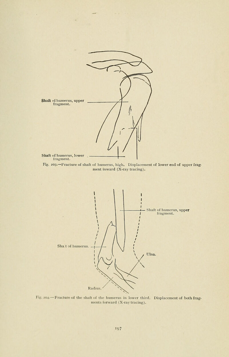 Shaft of humerus, upper fragment. Shaft of humerus, lower fragment. Fig. 203.—Fracture of shaft of humerus, high. Displacement of lower end of upper frag- ment inward (X-ray tracing). Sha-1 of humerus. Shaft of humerus, upper fragment. Ulna. FiK. 204.—Fracture of the shaft of the humerus in lower third. Displacement of both frag- ments forward (X-ray tracing). tq7