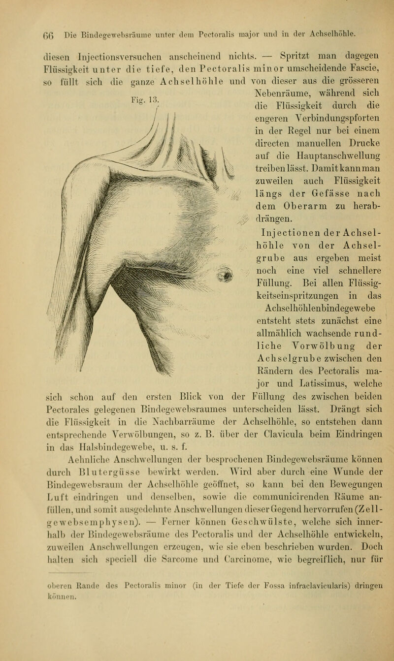 Gfi Die Bindegewebsräume unter dem Pectoralis major und in der Achselhöhle. Fiar. 13. diesen Injectionsversuchen anscheinend nichts. — Spritzt man dagegen Flüssigkeit unter die tiefe, den Pectoralis minor umscheidende Fascie, so füllt sich die ganze Achselhöhle und von dieser aus die grösseren Nebenräume, während sich die Flüssigkeit durch die engeren Verbindungspforten in der Regel nur bei einem directen manuellen Drucke auf die Hauptanschwellung treiben lässt. Damit kann man zuweilen auch Flüssigkeit längs der Gefässe nach dem Oberarm zu herab- drängen. Injectionen der Achsel- höhle von der Achsel- grube aus ergeben meist noch eine viel schnellere Füllung. Bei allen Flüssig- keitseinspritzungen in das Achsel höhlenbindegewebe entsteht stets zunächst eine allmählich wachsende rund- liche Vorwölbung der Achselgrube zwischen den Rändern des Pectoralis ma- jor und Latissimus, welche sich schon auf den ersten Blick von der Füllung des zwischen beiden Pectorales gelegenen Bindegewebsraumes unterscheiden lässt. Drängt sich die Flüssigkeit in die Nachbarräume der Achselhöhle, so entstehen dann entsprechende Verwölbungen, so z. B. über der Clavicula beim Eindringen in das Halsbindegewebe, u. s. f. Aehnliche Anschwellungen der besprochenen Bindegewebsräume können durch Blutergüsse bewirkl werden. Wird aber durch eine Wunde der Bindegewebsraum der Achselhöhle geöffnet, so kann bei den Bewegungen Luft eindringen und denselben, sowie die communicirenden Räume an- füllen, und somit ausgedehnte Anschwellungen dieser Gegend hervorrufen (Zell- gewebsemphysen). — Ferner können Geschwülste, welche sich inner- halb der Bindegewebsräume des Pectoralis und der Achselhöhle entwickeln, zuweilen Anschwellungen erzeugen, wie sie eben beschrieben wurden. Doch Indien sich speciell die Sarcome und Carcinome, wie begreiflich, nur für oberen Rande des Pectoralis minor (in der Tiefe der Fossa infraclavicularis) dringen können.