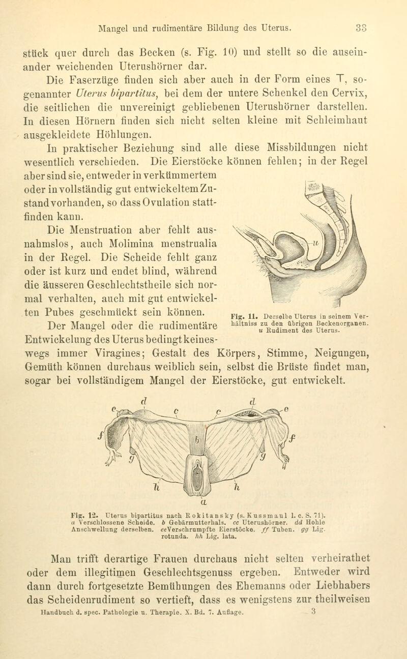 stück quer durch das Becken (s. Fig. 10) und stellt so die ausein- ander weichenden Uterushörner dar. Die Faserzüge finden sich aber auch in der Form eines T, so- genannter Uterus bipartitus, bei dem der untere Schenkel den Cervix, die seitlichen die unvereinigt gebliebenen Uterushörner darstellen. In diesen Hörnern finden sich nicht selten kleine mit Schleimhaut ausgekleidete Höhlungen. In praktischer Beziehung sind alle diese Missbildungen nicht wesentlich verschieden. Die Eierstöcke können fehlen; in der Regel aber sind sie, entweder in verkümmertem oder in vollständig gut entwickeltem Zu- stand vorhanden, so dass Ovulation statt- finden kann. Die Menstruation aber fehlt aus- nahmslos, auch Molimina menstrualia in der Regel. Die Scheide fehlt ganz oder ist kurz und endet blind, während die äusseren Geschlechtstheile sich nor- mal verhalten, auch mit gut entwickel- ten Pubes geschmückt sein können. Der Mangel oder die rudimentäre Entwickelung des Uterus bedingt keines- wegs immer Viragines; Gestalt des Körpers, Stimme, Neigungen, Gemüth können durchaus weiblich sein, selbst die Brüste findet man, sogar bei vollständigem Mangel der Eierstöcke, gut entwickelt. Flg. 11. Derselbe Uterus in seinem Ver- hältniss zu den übrigen ßeckenorganen. u Budiment des Uterus. Fig. 12. Uterus bipartitus nach E okitansky (s. Kussmaul 1. c. S. 71). a Verschlossene Scheide, b Gebärmntterhals. ce Uterushörner. dd Hohle Anschwellung derselben. eeVerschrnmpfte Eierstöcke, ff Tuben, gg Lig. rotunda. hfi. Lig. lata. Man trifft derartige Frauen durchaus nicht selten verheirathet oder dem illegitimen Geschlechtsgenuss ergeben. Entweder wird dann durch fortgesetzte Bemühungen des Ehemanns oder Liebhabers das Scheidenrudiment so vertieft, dass es wenigstens zur theilweisen Handbuch d. spec. Pathologie u. Therapie. X. Bd. 7. Auflage. 3