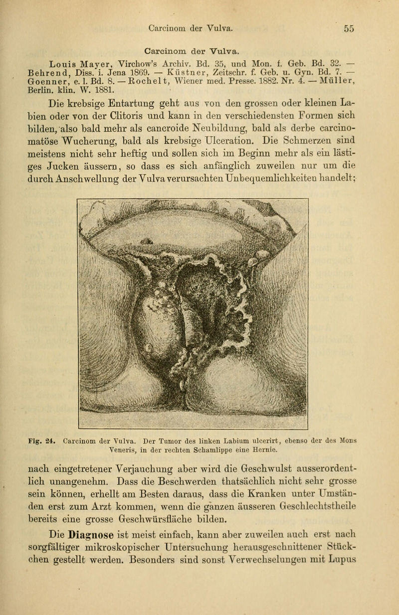 Carcinom der Vulva. Louis Mayer, Virchow's Archiv. Bd. 35, und Mon. f. Geb. Bd. 32. — Behrend, Diss. i. Jena 1869. — Küstner, Zeitschr. f. Geb. u. Gyn. Bd. 7. — Goenner, e. I. Bd. 8.— Rochelt, Wiener med. Presse. 1882. Nr. 4.— Müller, Berlin, klin. W. 1881. Die krebsige Entartung geht aus von den grossen oder kleinen La- bien oder von der Clitoris und kann in den verschiedensten Formen sich bilden, also bald mehr als cancroide Neubildung, bald als derbe carcino- matöse Wucherung, bald als krebsige Ulceration. Die Schmerzen sind meistens nicht sehr heftig und sollen sich im Beginn mehr als ein lästi- ges Jucken äussern, so dass es sich anfänglich zuweilen nur um die durch Anschwellung der Vulva verursachten Unbequemlichkeiten handelt; U-k^fr^s^. Flg. 24. Carcinom der Vulva. Der Tumor des linken Labium ulcerirt, ebenso der des Mens Veneris, in der rechten Schamlippe eine Hernie. nach eingetretener Verjauchung aber wird die Geschwulst ausserordent- lich unangenehm. Dass die Beschwerden thatsächlich nicht sehr grosse sein können, erhellt am Besten daraus, dass die Kranken unter Umstän- den erst zum Arzt kommen, wenn die ganzen äusseren Geschlechtstheile bereits eine grosse Geschwürsfläche bilden. Die Diagnose ist meist einfach, kann aber zuweilen auch erst nach sorgfältiger mikroskopischer Untersuchung herausgeschnittener Stück- chen gestellt werden. Besonders sind sonst Verwechselungen mit Lupus