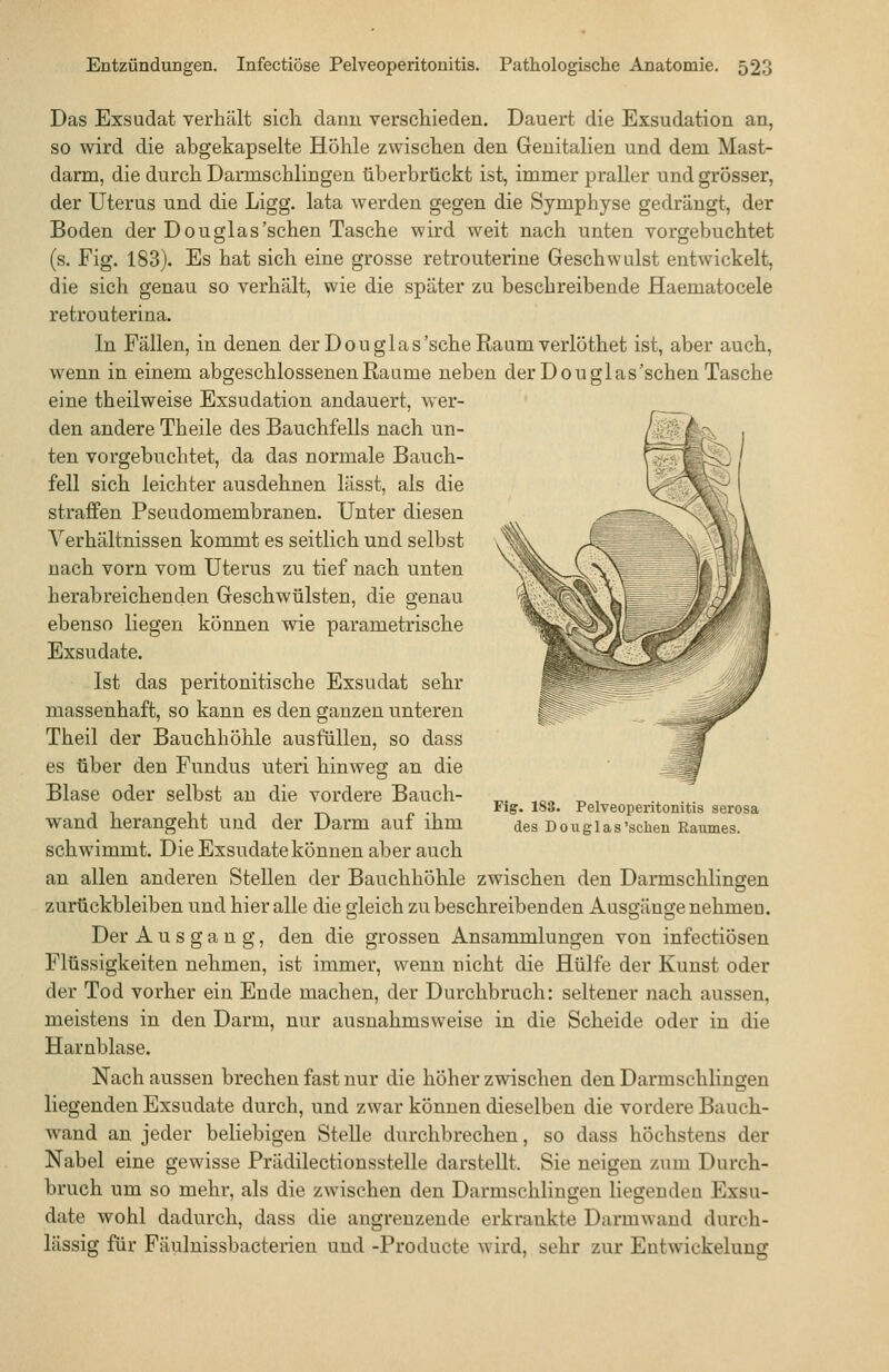 Das Exsudat verhält sich dann verschieden. Dauert die Exsudation an, so wird die abgekapselte Höhle zwischen den Genitalien und dem Mast- darm, die durch Darmschlingen überbrückt ist, immer praller und grösser, der Uterus und die Ligg. lata werden gegen die Symphyse gedrängt, der Boden der Douglas'schen Tasche wird weit nach unten vorgebuchtet (s. Fig. 183). Es hat sich eine grosse retrouterine Geschwulst entwickelt, die sich genau so verhält, wie die später zu beschreibende Haematocele retrouterina. In Fällen, in denen derDouglas'scheRaumverlöthet ist, aber auch, wenn in einem abgeschlossenen Räume neben der Douglas'schen Tasche eine theilweise Exsudation andauert, wer- den andere Theile des Bauchfells nach un- ten vorgebuchtet, da das normale Bauch- fell sich leichter ausdehnen lässt, als die straffen Pseudomembranen. Unter diesen Verhältnissen kommt es seitlich und selbst nach vorn vom Uterus zu tief nach unten herab reich enden Geschwülsten, die genau ebenso liegen können wie parametrische Exsudate. Ist das peritonitische Exsudat sehr massenhaft, so kann es den ganzen unteren Theil der Bauchhöhle ausfüllen, so dass es über den Fundus uteri hinweg an die Blase oder selbst an die vordere Bauch- wand herangeht und der Darm auf ihm schwimmt. Die Exsudate können aber auch an allen anderen Stellen der Bauchhöhle zwischen den Darmschlingen zurückbleiben und hier alle die gleich zu beschreibenden Ausgänge nehmeo. Der Ausgang, den die grossen Ansammlungen von infectiösen Flüssigkeiten nehmen, ist immer, wenn nicht die Hülfe der Kunst oder der Tod vorher ein Ende machen, der Durchbruch: seltener nach aussen, meistens in den Darm, nur ausnahmsweise in die Scheide oder in die Harnblase. Nach aussen brechen fast nur die höher zwischen den Darmschlingen liegenden Exsudate durch, und zwar können dieselben die vordere Bauch- wand an jeder beliebigen Stelle durchbrechen, so dass höchstens der Nabel eine gewisse Prädilectionsstelle darstellt. Sie neigen zum Durch- bruch um so mehr, als die zwischen den Darmschlingen liegenden Exsu- date wohl dadurch, dass die angrenzende erkrankte Darmwand durch- lässig für Fäulnissbacterien und -Producte wird, sehr zur Entwickelung Fig. 188. Pelveoperitonitis serosa des Douglas'schen Eaumes.