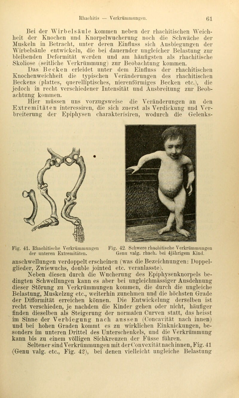 Bei der Wirbelsäule kommen neben der rliacliitischen Weich- heit der Knochen und Knorpelwucherung- noch die Schwäche der Muskeln in Betracht, unter deren Einfluss sich Ausbiegungen der AVirbelsäule entwickeln, die bei dauernder ungleicher Belastung zur bleibenden Deformität werden und am häufigsten als rhachitische Skoliose (seitliche Verkrümmung) zur Beobachtung kommen. Das Becken erleidet unter dem Einfluss der rhachitischen Knochenweichheit die typischen Veränderungen des rhachitischen Beckens (plattes, querelliptisches, nierenförmiges Becken etc.), die jedoch in recht verschiedener Intensität und Ausbreitung zur Beob- achtung kommen. Hier müssen uns vorzugsweise die Veränderungen an den Extremitäten interessiren, die sich zuerst als Verdickung und Ver- breiterung der Epiphysen charakterisiren, wodurch die Gelenks- Fig. 4:1. Ehaebitiselie Verkrümmungen der unteren Extremitäten. Fig. 42. Schwere rhacliitiselie Verkrümmungen Genu valg. rhaeh. bei ijälirigem Kind. Anschwellungen verdoppelt erscheinen (was die Bezeichnungen: Doppel- glieder, Zwiewuchs, double jointed etc. veranlasste). Neben diesen durch die Wucherung des Epiphysenknorpels be- dingten Schwellungen kann es aber bei ungleichmässiger Ausdehnung dieser Störung zu Verkrümmungen kommen, die durch die ungleiche Belastung, Muskelzug etc., weiterhin zunehmen und die höchsten Grade der Diiibrmität erreichen können. Die Entwickelung derselben ist recht verschieden, je nachdem die Kinder gehen oder nicht, häufiger finden dieselben als Steigerung der normalen Curven statt, das heisst im Sinne der Verbiegung nach aussen (Concavität nach innen) und bei hohen Graden kommt es zu wirklichen Einknickungen, be- sonders im unteren Drittel des Unterschenkels, und die Verkrümmung kann bis zu einem völligen Sichkreuzen der Füsse führen. Seltener sind Verkrümmungen mit derConvexitätnachinnen, Fig. 41 (Genu valg. etc., Fig. 42j, bei denen vielleicht ungleiche Belastung