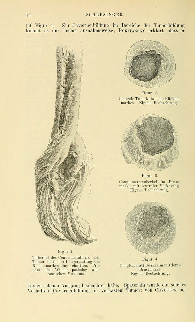 (cf. Figur 4). Zur Cavernenbildung im Bereiche der Tumorbildung kommt es nur liöclist ausnahmsweise; Rokitansky erklärt, dass er Figur 2. Centrale Tuberkulose des Rücken- markes. Eigene Beobachtunff. Eigur 3. Congiomerattnberkel im Brust- marke mit centraler Verkäsung. Eigene Beobachtung. Figur 1. Tuberkel des Conus medullaris. Der Tumor ist in der Längsrichtung des Rückenmarkes eingeschnitten. Prä- parat des Wiener patholog. ana- tomischen Museums. Figur 4. Conglomerattuberkel im mittleren Brustmarke. Eigene Beobachtung. keinen solchen Ausgang beobachtet habe. Späterhin Avurde ein solches Verhalten (Cavernenbildung in verkästem Tumor) von Chvostek be-