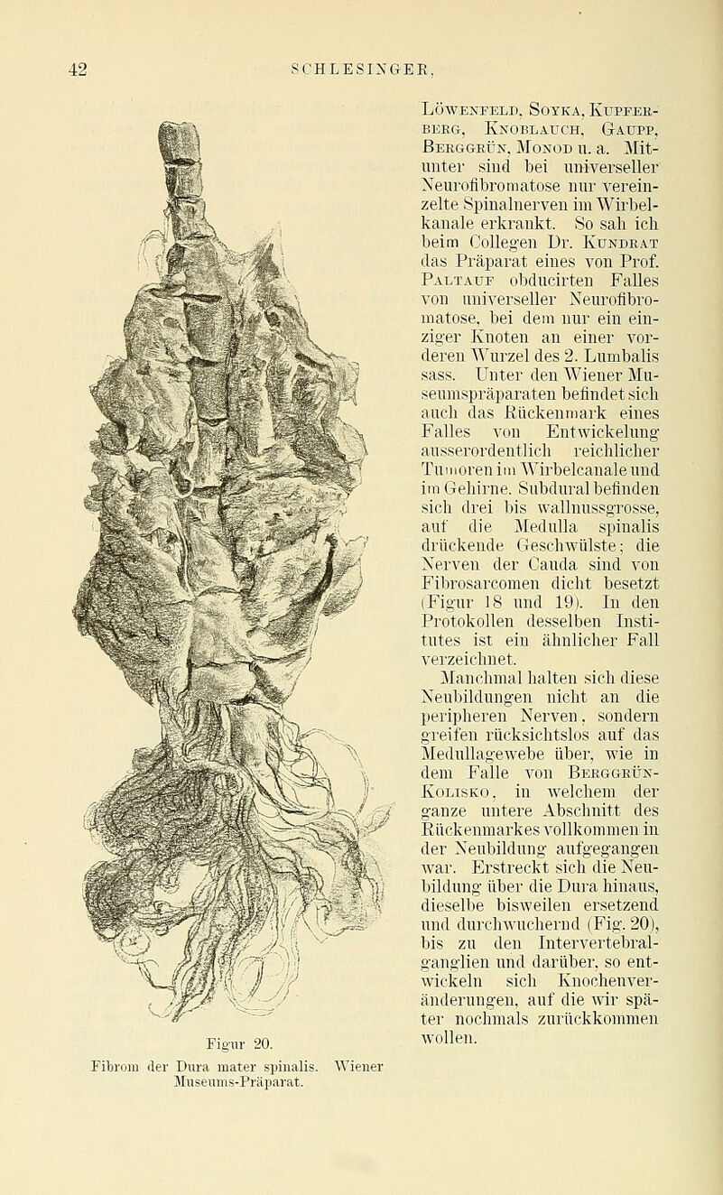 Figur 20. Fibrom der Dura mater spinalis. Wiener Museums-Präparat. LÖWBIJrELD, SOYKA, KUPFEB- BERG, Knoblauch, Gaüpp, Beeggeün, Monod u. a. Mit- unter sind bei universeller Neurofibromatose nur verein- zelte Spinalnerven im Wirbel- kanale erkrankt. So sali ich beim CoUegen Dr. Kundeat das Präparat eines von Prof. Paltauf obducirten Falles von universeller Neurofibro- matose, bei dem nur ein ein- ziger Knoten an einer vor- deren Wurzel des 2. Lumbalis sass. Unter den Wiener Mu- seumspräparaten befindet sich auch das ßückenmark eines Falles von Ent Wickelung ausserordentlich reichlicher Tumoren im Wirbelcanaleund im Gehirne. Subdural befinden sich drei bis wallnussgrosse, auf die Medulla spinalis drückende Geschwülste; die Nerven der Cauda sind von Fibrosarcomen dicht besetzt (Figur 18 und 19). In den Protokollen desselben Insti- tutes ist ein ähnlicher Fall verzeichnet. Manchmal halten sich diese Neubildungen nicht an die peripheren Nerven, sondern greifen rücksichtslos auf das Medullagewebe über, wie in dem Falle von Beeggeün- KoLisKo, in welchem der ganze untere Abschnitt des Eückenmarkes vollkommen in der Neubildung aufgegangen war. Erstreckt sich die Neu- bildung über die Dura hinaus, dieselbe bisweilen ersetzend und dnrchwuchernd (Fig. 20), bis zu den Intervertebral- ganglien und darüber, so ent- wickeln sich Knochenver- änderungen, auf die wir spä- ter nochmals zurückkommen wollen.