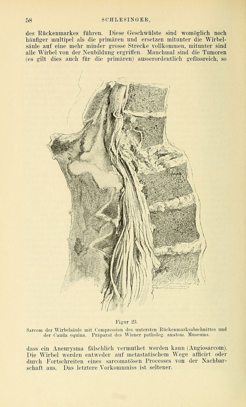 des Rückenmarkes führen. Diese Geschwülste sind womöglich noch häufiger multipel als die primären und ersetzen mitunter die Wirbel- säule auf eine mehr minder grosse Strecke vollkommen, mitunter sind alle Wirbel von der Neubildung ergriffen. Manchmal sind die Tumoren (es gilt dies auch für die primären) ausserordentlich gefässreich, so Figur 23. Sarcom der AVirbelsäiüe mit Corapression fies untersten Eüokenraarksabsclinittes und der Oauda equina. Präparat des Wiener patholog. anatom. Museums. dass ein Aneurj'sma fälschlich vermuthet werden kann (Angiosarcom). Die Wirbel werden entweder auf metastatischem Wege afficirt oder durch Fortschreiten eines sarcomatösen Processes von der Nachbar- schaft aus. Das letztere Vorkommniss ist seltener.