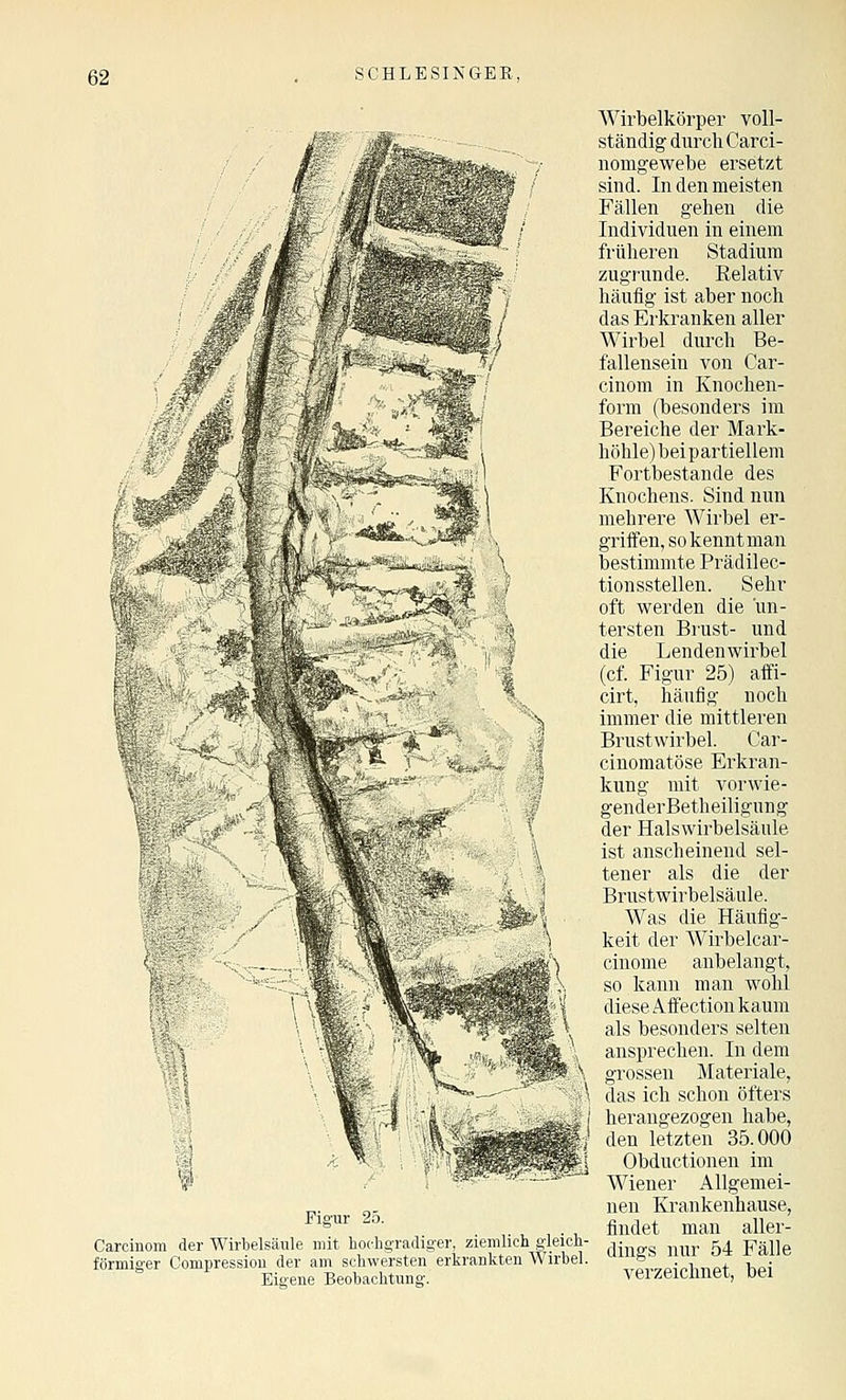 Figur 25. Carcinom der Wirbelsäule mit hochgradiger, ziemlich gleich- förmiger Compression der am schwersten erkrankten Wirbel. Eigene Beobachtung. AVirbelkörper voll- ständig durch Carci- nomgewebe ersetzt sind. In den meisten Fällen gehen die Individuen in einem früheren Stadium zugrunde. Relativ häufig ist aber noch das Erkranken aller Wirbel durch Be- fallensein von Car- cinom in Knochen- form (besonders im Bereiche der Mark- höhle)beipartiellem Fortbestande des Knochens. Sind nun mehrere Wirbel er- griifen, so kennt man bestimmte Prädilec- tionsstellen. Sehr oft werden die un- tersten Brust- und die Lendenwirbel (cf. Figur 25) affi- cirt, häufig noch immer die mittleren Brustwirbel. Car- cinomatöse Erkran- kung mit vorwie- genderBetheiligung der Halswirbelsäule ist anscheinend sel- tener als die der Brustwirbelsäule. Was die Häufig- keit der Wirbelcar- cinonie anbelangt, so kann man wohl diese Affection kaum als besonders selten ansprechen. In dem grossen Materiale, das ich schon öfters herangezogen habe, den letzten 35.000 Obductionen im Wiener Allgemei- nen Krankenhause, findet man aller- dings nur 54 Fälle verzeichnet, bei