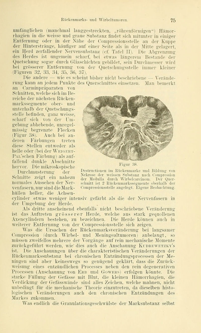 umfäiigiiclien (maiiclimal lango-estreckten. „rölireiiförmigen) Hämor- rhagien in die weisse und graue Substanz findet sich mitunter in ehüger Entfernung oder in der Nähe der Compressionsstelle an der Kuppe der Hinterstränge, häufiger auf einer Seite als in der :\ritte gelagert, ein Herd zerfallender Nervensubstanz (cf. Taiel II). Die Abg'renzung des Herdes ist ungemein scharf, bei etwas längerem Bestände der Quetschung sogar dui'ch Gliaschichten gelnldet, sein Durchmesser wird bei grösserer Entfernung von der Quetschungsstelle immer kleiner (Figuren 32, 33, 34, 35, 36, 37). Die andere — Avie es scheint bisher nicht beschriebene — Verände- rung kann an jedem Punkte des Querschnittes einsetzen. Man bemerkt an Carminpräparaten von Schnitten, welche sich im Be- reiche der nächsten Rücken- markssegmente ober- und unterhalb der Quetschungs- stelle befinden, ganz weisse, scharf sich von der Um- gebung abhebende, unregel- mässig begrenzte Flecken (Figur 38). Auch bei an- deren Färbungen treten diese Stellen entweder als helle oder (bei der Weigeet- PALschen Färbung) als auf- fallend dunkle Abschnitte hervor. Die mikroskopisclie Durchmusterung der Schnitte zeigt ein nahezu normales Aussehen der Ner- venfasern, nur sind dieMark- hüUen heller, die Achsen- cylinder etwas weniger intensiv gefärbt als die der Nervenfasern in der Umgebung der Herde. Als dritte anscheinend ebenfalls nicht beschriebene Veränderung ist das Auftreten grösserer Herde, welche aus stark gequollenen Axencylindern bestehen, zu bezeichnen. Die Herde können auch in weitei-er Entfernung von der Compressionsstelle sich zeigen. Was die Ursachen der Rückenmarksveränderuug bei langsamer (ompression (durch Wirbel- und Meuingealtumoren) anbelangt, so müssen zweifellos mehrere der Vorgänge auf rein mechanische ]\romente zurückgeführt werden, wie dies auch die Anschauung Kudeewetzky's ist. Die Anschauungen über die charakteristischen Veränderungen der Eückenmarkssubstanz bei chronischen Entzündungsprocessen der Me- ningen sind aber keineswegs so genügend geklärt, dass die Zurück- weisung eines entzündlichen Processes neben den rein degenerativen Processen (Anschauung von Erb und Gowers) erfolgen könnte. Die starke Füllung der Gefässe mit Blut, die kleinen Hämorrhagien, die Verdickung der Gefässwände sind alles Zeichen, welche mahnen, nicht nnltedingt für die mechanische Theorie einzutreten, da dieselben histo- logisclien ^'eränderung•en auch den chronischen Entzündungen des ;^^arkes zukommen. Was endlich die Granulationsgeschwülste der Marksubstanz selbst Figur 38. Destruetionen im Kückeumarke und Bildung von Nelirose der wri.;-^in Substanz nach Compressiou der Medulla dinvh \\ irbelcaroinom. Der Quer- schnitt ist 2 l.'iiikcinnarkssegmente oberhalb der Compressionsstelle angelegt. Eigene Beobachtung.