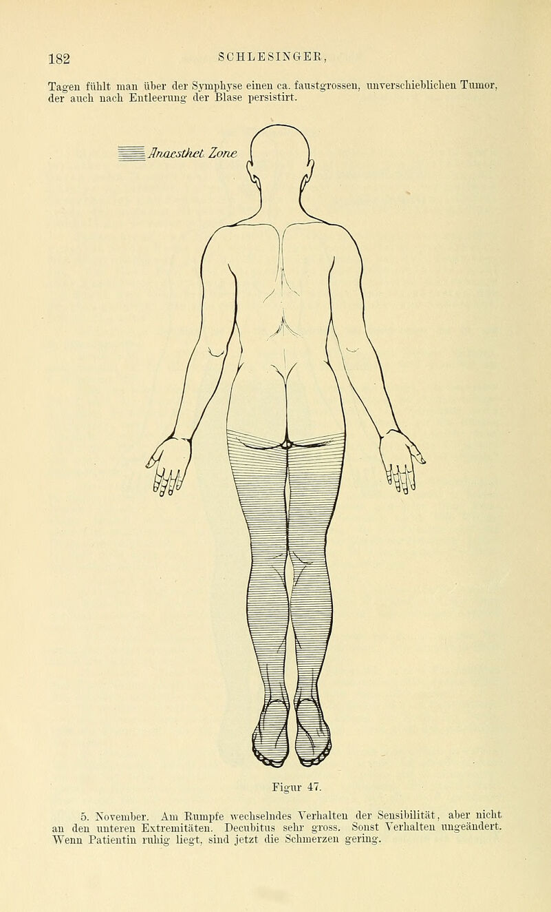 Tag-eu fühlt man über der S3'mphj'se einen ca. faustgi'osseu, unverscliieblichen Tumor, der auch nach Entleerung- der Blase persistirt. \]Irm£sthet Zone Figur 47. 5. November. Am Rumpfe wechselndes Verhalten der Sensibilität, aber nicht an den unteren Extremitäten. Decubitus sehr gross. Sonst Verhalten ungeändert. Wenn Patientin ruhig- liegt, sind jetzt die Schmerzen gering-.