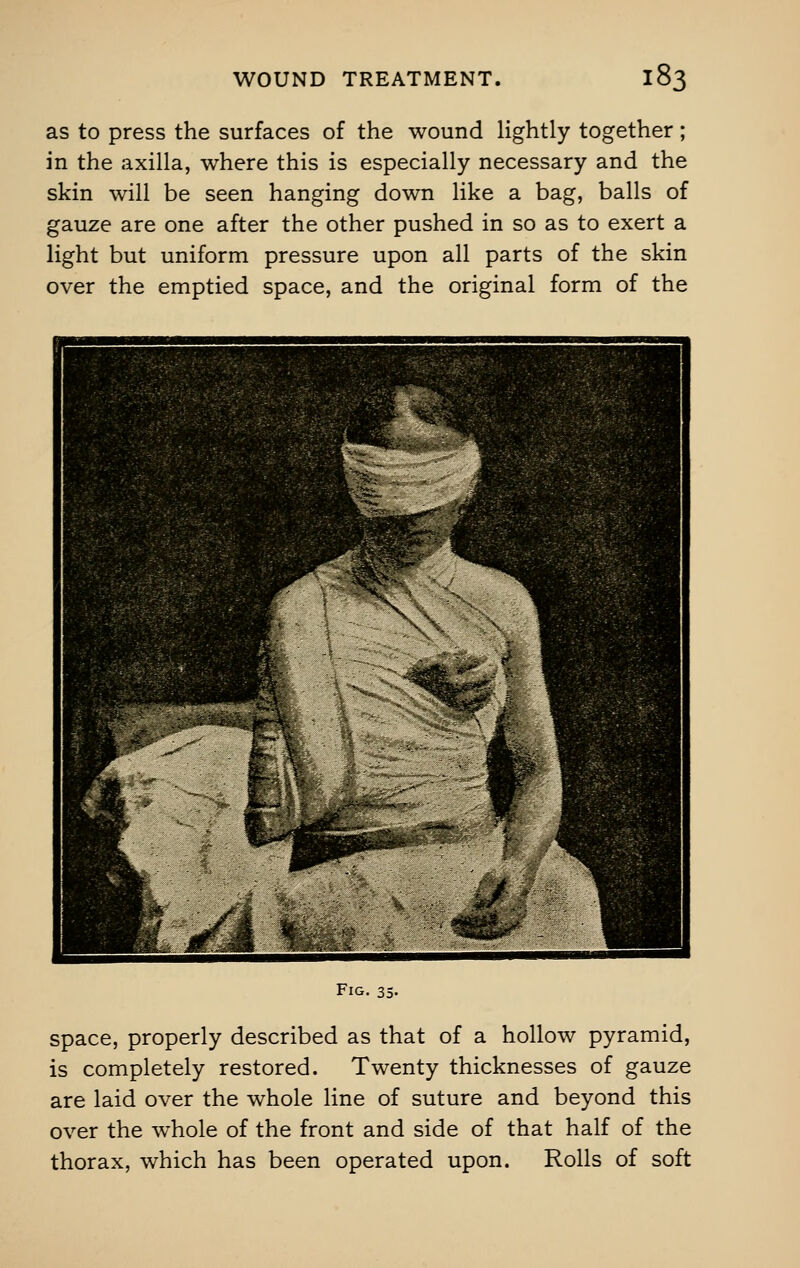 as to press the surfaces of the wound lightly together; in the axilla, where this is especially necessary and the skin will be seen hanging down like a bag, balls of gauze are one after the other pushed in so as to exert a light but uniform pressure upon all parts of the skin over the emptied space, and the original form of the Fig. 35- space, properly described as that of a hollow pyramid, is completely restored. Twenty thicknesses of gauze are laid over the whole line of suture and beyond this over the whole of the front and side of that half of the thorax, which has been operated upon. Rolls of soft