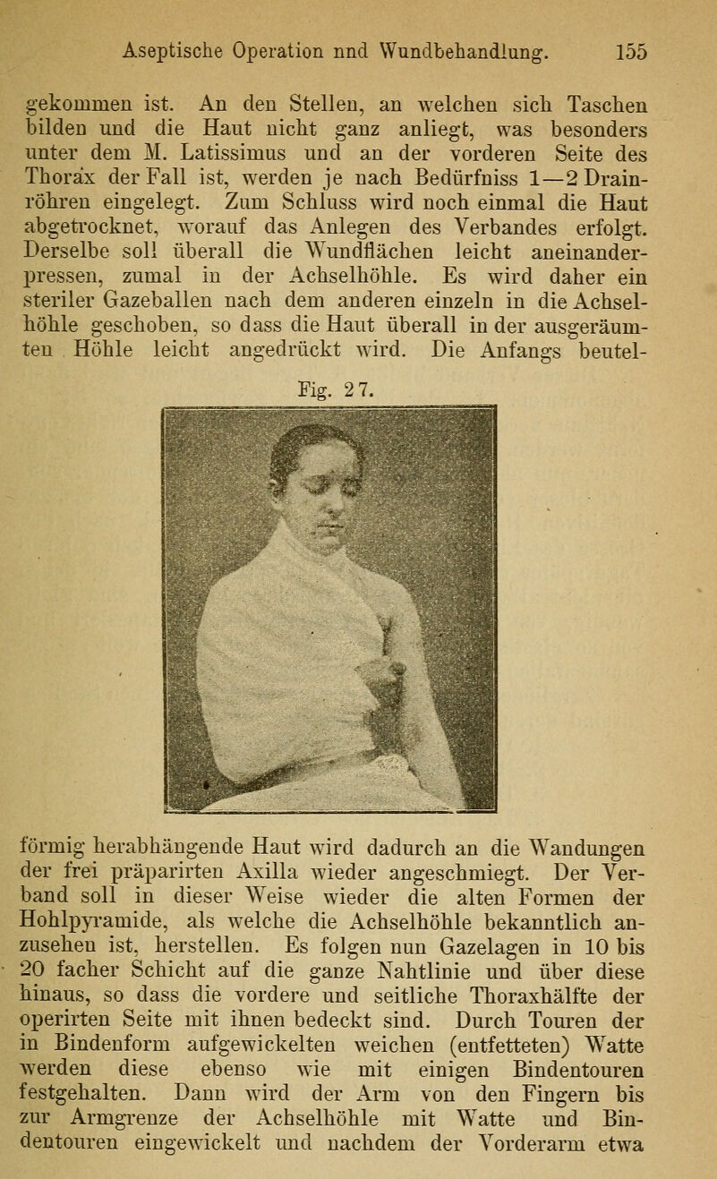 gekommen ist. An den Stelleu, an welchen sich Taschen bilden und die Haut nicht ganz anliegt, was besonders unter dem M. Latissimus und an der vorderen Seite des Thorax der Fall ist, werden je nach Bedürfniss 1—2 Drain- röhren eingelegt. Zum Schluss wird noch einmal die Haut abgetrocknet, worauf das Anlegen des Verbandes erfolgt. Derselbe soll überall die Wundflächen leicht aneinander- pressen, zumal in der Achselhöhle. Es wird daher ein steriler Gazeballen nach dem anderen einzeln in die Achsel- höhle geschoben, so dass die Haut überall in der ausgeräum- ten Höhle leicht angedrückt wird. Die Anfangs beutel- Fig. 2 7. förmig herabhängende Haut wird dadurch an die Wandungen der frei präparirten Axilla wieder angeschmiegt. Der Ver- band soll in dieser Weise wieder die alten Formen der Hohlpyi-amide, als welche die Achselhöhle bekanntlich an- zusehen ist, herstellen. Es folgen nun Gazelagen in 10 bis 20 facher Schicht auf die ganze Nahtlinie und über diese hinaus, so dass die vordere und seitliche Thoraxhälfte der operirten Seite mit ihnen bedeckt sind. Durch Touren der in Bindenform aufgewickelten weichen (entfetteten) Watte werden diese ebenso wie mit einigen Bindentouren festgehalten. Dann ward der Arm von den Fingern bis zur Armgrenze der Achselhöhle mit Watte und Bin- dentouren eingewickelt und nachdem der Vorderarm etwa