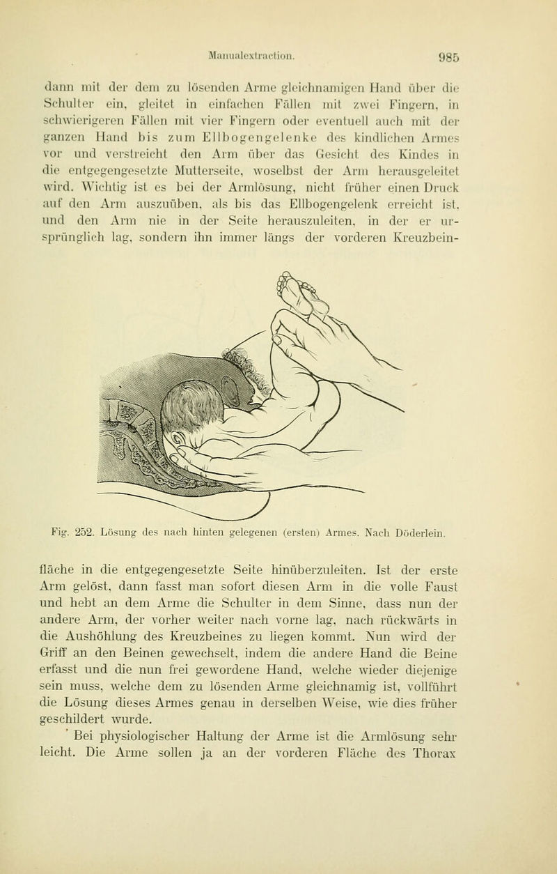dann mit der dem zu lösenden Arme gleichnamigen Hund über die Schulter ein, gleitet in einlachen Fällen mit zwei Fingern, in schwierigeren Fällen mit vier Fingern oder eventuell auch mit der ganzen Hand bis zum Ellbogengelenke des kindlichen Armes vor und verstreicht den Arm über das Gesicht des Kindes in die entgegengt'st'tzte Mutterseite, woselbst der Arm herausgeleitet wird. Wichtig ist es bei der Armlösung, nicht früher einen Druck auf den Arm auszuüben, als bis das Ellbogengelenk erreicht ist. und den Arm nie in der Seite herauszuleiten, in der er ur- sprünglich lag. sondern ihn immer längs der vorderen Kreuzbein- Fig. 252. Lösung des nach hinten gelegenen (ersten) Armes. Nach Döderlein. fläche in die entgegengesetzte Seite hinüberzuleiten. Ist der erste Arm gelöst, dann fasst man sofort diesen Arm in die volle Faust und hebt an dem Arme die Schulter in dem Sinne, dass nun der andere Arm, der vorher weiter nach vorne lag, nach rückwärts in die Aushöhlung des Kreuzbeines zu Hegen kommt. Nun mrd der Griff an den Beinen gewechselt, indem die andere Hand die Beine erfasst und die nun frei gewordene Hand, welche wieder diejenige sein muss, welche dem zu lösenden Arme gleichnamig ist, vollführt die Lösung dieses Armes genau in derselben Weise, wie dies früher geschildert wurde. * Bei physiologischer Haltung der Arme ist die Armlösung sehr leicht. Die Arme sollen ja an der vorderen Fläche des Thorax