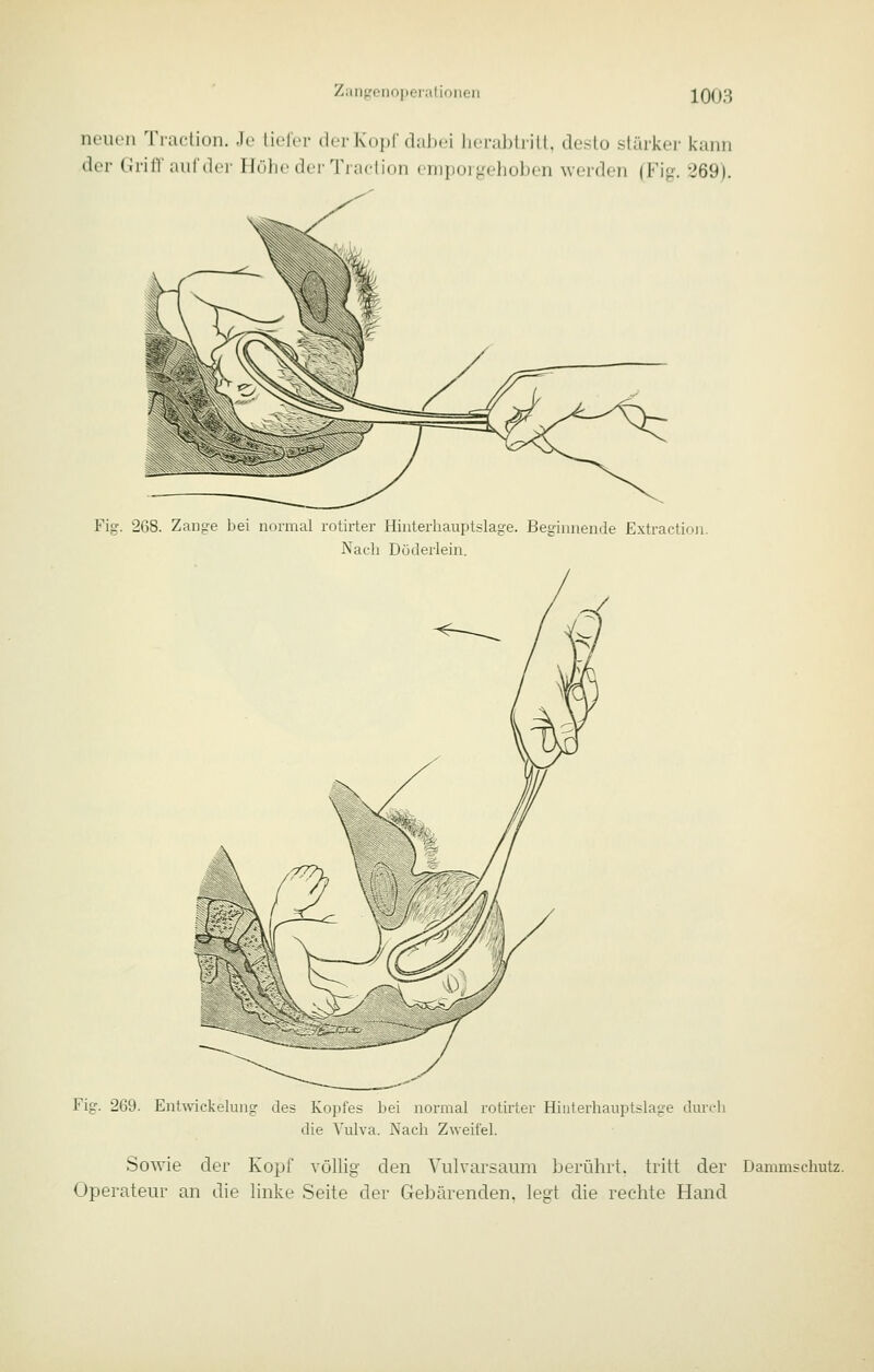 neiu'ii Traction. .le \w\vr der Kopf dalx.i licrabliill, doslo slärker kann der Grifl'aurdcr Ilölic der'riadion emporgehoben worden (Fig. 269). Fig. 268. Zange bei iioimal roürter Hinterhauptslage. Beginnende Extractinii. Nacli Düderlein. Fig. 269. Entwickelung des Kopfes bei normal rotirter Hiiiterhauptslage durch die Vulva. Nach Zweifel. Sowie der Kopf völlig den Vulvarsaum berührt, tritt der Dammschutz. Operateur an die linke Seite der Gebärenden, legt die rechte Hand