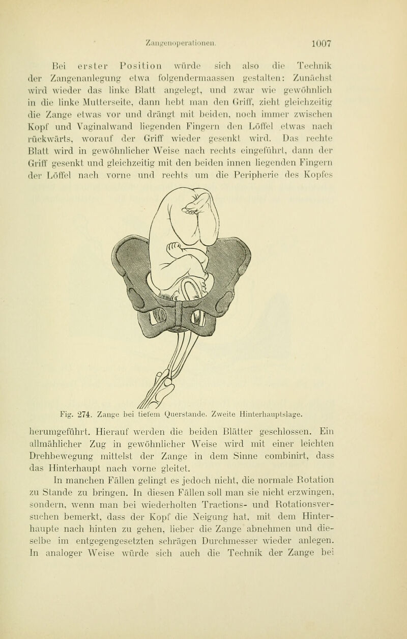 l'x'i {M'slcr Position wiirdr sich also die 'rccliiiik der /anyciiaiilc^iiiiL;' rlwa folgendermaassen geslallcii: ZuiiädisL wii-d wieder das linke Blatt, aii<ieleg-l, und zwar wie g-ewöliiilidi in die linke Mutterseite, dann hebt man den Griff, zieht gleichzeitig die Zange etwas vor und drängt mit ])eiden, noch immer zwischen Kopf und Vaginahvand liegenden Fingern den Löffel etwas nach rückwärts, worauf der Griff wieder gesenkt wird. Das rechte 151att wird in gewöhnlicher Weise nach rechts eingeführt, dann der Griff gesenkt und gleichzeitig mit den beiden innen liegenden Fingern der Löffel nach vorne und rechts um die Periphei-io des Kopfes Fig. 274. Zange bei tiefem Querstaiide. Zweite Hinterhauptslage. herumgeführt. Hierauf werden die beiden Blätter geschlossen. Ein allmähhcher Zug in gewöhnlicher Weise wird mit einer leichten Drehbewegung mittelst der Zange in dem Sinne combinirt, dass das Hinterhaupt nach vorne gleitet. In manchen Fällen gelingt es jedoch nicht, die normale Rotation zu Stande zu bringen. In diesen Fällen soll man sie nicht erzwingen, sondern, wenn man bei wiederholten Tractions- und Rotationsver- suchen bemerkt, dass der Kopf die Neigung hat, mit dem Hinter- haupte nach hinten zu gehen, lieber die Zange abnehmen und die- selbe im entgegengesetzten schrägen Durchmesser wieder anlegen. In analoger Weise würde sich auch die Technik der Zange bei