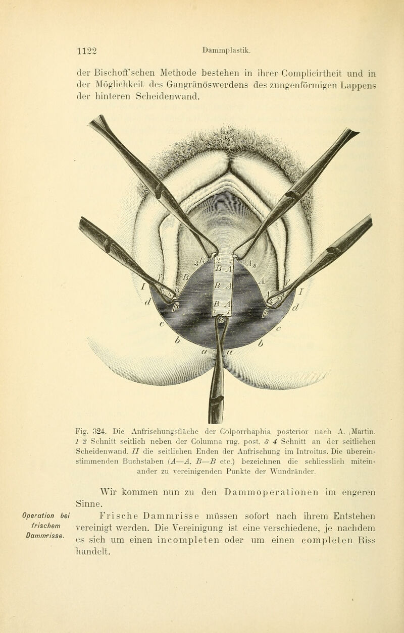 der Bischoff'schen Methode bestehen in ihrer GompHcirtheit und in der Möglichkeit des Gangränöswerdens des zungenförmigen Lappens der hinteren Scheidenwand. Fig. 324. Die Aiifrischungsfläche der Golporrhaphia posterior nach A. ,Martin. 1 2 Schnitt seithch neben der Columna rüg. post. 3 4 Schnitt an der seitüchen Scheidenwand. 11 die seithchen Enden der Anfrischung im Introitus. Die überein- stimmenden Buchstaben [A—A. B—B etc.) bezeichnen die schhesshcli mitein- ander zu vereinigenden Punkte der Wundränder. Wir kommen nun zu den Dammoperationen im engeren Sinne. Operation bei Frische Dammrisse müssen sofort nach ihrem Entstehen frischem vereinigt werden. Die Vereinigunsr ist eine verschiedene, ie nachdem ammrisse. ^^ g-^j^ ^^^ einen incompleten oder um einen completen Riss handelt.