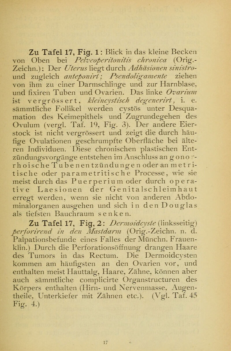 von Oben bei Pelveoperitonitis chronica (Orig.- Zeichn.): Der Uterus liegt durch Adhäsionen sinistro- und zugleich anteponiri; Psendoligamente ziehen von ihm zu einer Darmschlinge und zur Harnblase, und fixiren Tuben und Ovarien. Das linke Ovarinm ist vergrössert. kleincxstisch degenerirt, i. e. sämmtliche Follikel werden cystös unter Desqua- mation des Keimepithels und Zugrundegehen des Ovulum (vergl. Tat. 19, Fig. 3). Der andere Eier- stock ist nicht vergrössert und zeigt die durch häu- fige Ovulationen geschrumpfte Oberfläche bei älte- ren Individuen. Diese chronischen plastischen Ent- zündungsvorgänge entstehen im Anschluss an gono :- rh oische Tube nentzün dun gen oder an m et ri- tische oder parametritisch e Processe, wie sie meist durch das Pue rperium oder durch opera- tive Laesionen der Genitalschleimhaut erregt werden, wenn sie nicht von anderen Abdo- minalorganen ausgehen und sich in den Douglas als tiefsten Bauchraum senken. Zu Tafel 17, Fig, 2: Dennoidcxste (linksseitig) perforirend in den Mastdarm (Orig.-Zeichn. n. d. Palpationsbefunde eines Falles der Münchn. Frauen- klin.) Durch die Perforationsöffnung drangen Haare des Tumors in das Rectum. Die Dermoidcvsten kommen am häufigsten an den Ovarien vor, und enthalten meist Hauttalg, Haare, Zähne, können aber auch sämmtliche complicirte Organstructuren des Körpers enthalten (Hirn- und Xervenmasse, Augen- theile. Unterkiefer mit Zähnen etc.). (^gl- Taf. 45 Fig. 4.)