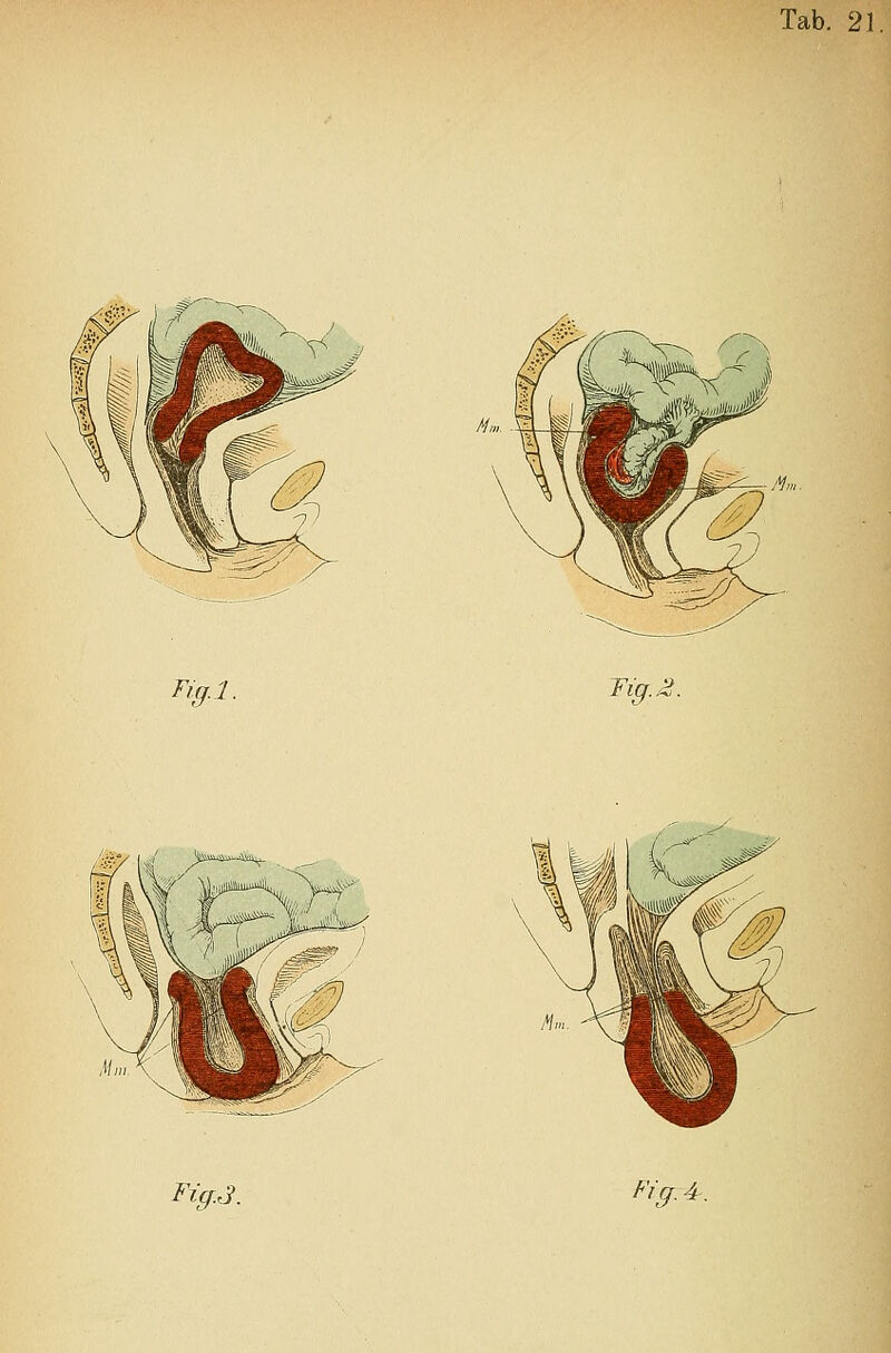 Tab. 21. /^ Fig.l. Tig., FicfJ. Fl ff. 4.