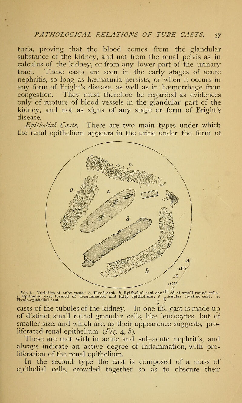 turia, proving that the blood comes from the glandular substance of the kidney, and not from the renal pelvis as in calculus of the kidney, or from any lower part of the urinary tract. These casts are seen in the early stages of acute nephritis, so long as h?ematuria persists, or when it occurs in any form of Bright's disease, as well as in haemorrhage from congestion. They must therefore be regarded as evidences only of rupture of blood vessels in the glandular part of the kidney, and not as signs of any stage or form of Bright'? disease. EpitJielial Casts. There are two main types under which the renal epithelium appears in the urine under the form ol Fiq. 4. Varieties o( tube casts: a, Elood cast; h. Epithelial cast oot>'' ed of small round cells; c, Epithelial cast formed of desquamated and fatty epithelium; rf ^y&,nular hyaline cast; Hyalo-epithelial cast. C/ casts of the tubules of the kidney. In one th^ cast is made up of distinct small round granular cells, like leucocytes, but of smaller size, and which are, as their appearance suggests, pro- liferated renal epithelium {Fig. 4, b). These are met with in acute and sub-acute nephritis, and always indicate an active degree of inflammation, with pro- liferation of the renal epithelium. In the second type the cast is composed of a mass of epithelial cells, crowded together so as to obscure their