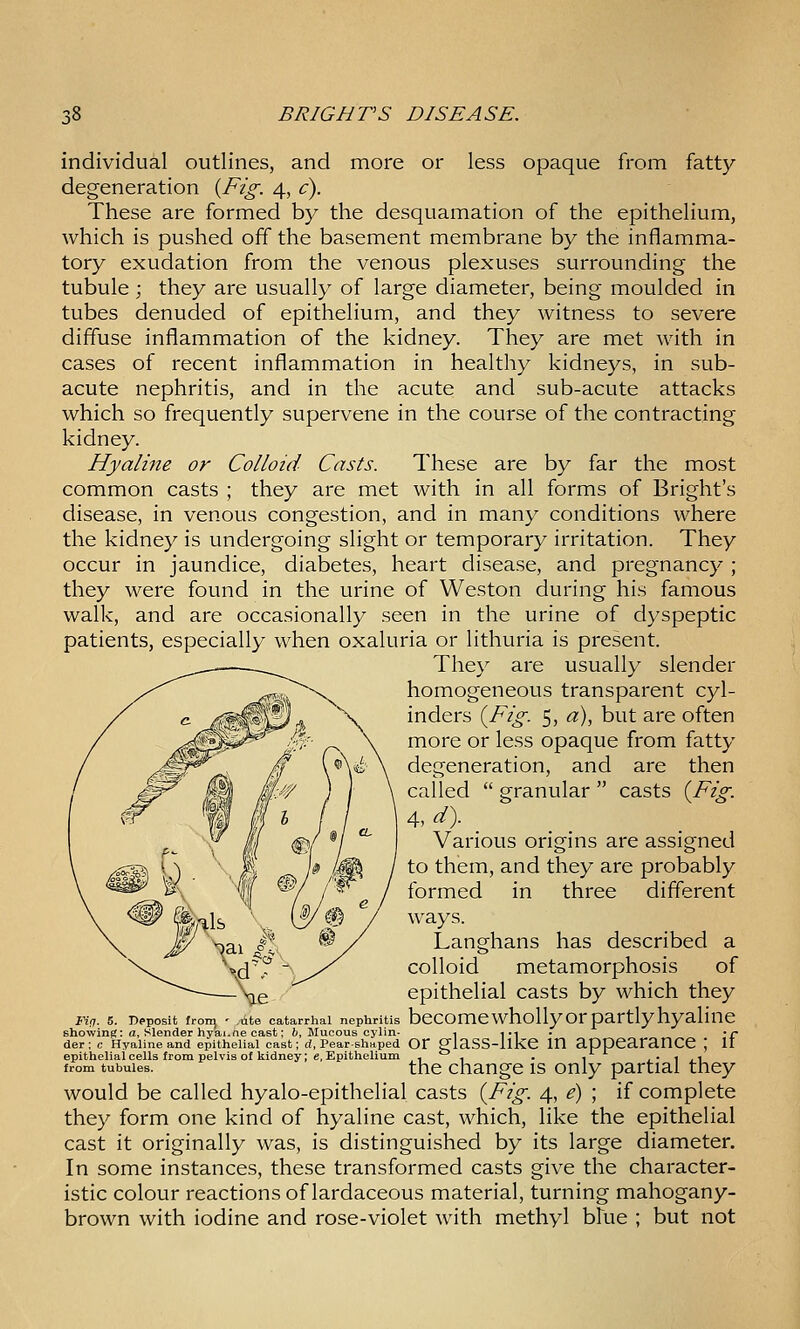 individual outlines, and more or less opaque from fatty degeneration {Fig. 4, c). These are formed by the desquamation of the epithelium, which is pushed off the basement membrane by the inflamma- tory exudation from the venous plexuses surrounding the tubule ; they are usually of large diameter, being moulded in tubes denuded of epithelium, and they witness to severe diffuse inflammation of the kidney. They are met with in cases of recent inflammation in healthy kidneys, in sub- acute nephritis, and in the acute and sub-acute attacks which so frequently supervene in the course of the contracting kidney. Hyaline or Colloid Casts. These are by far the most common casts ; they are met with in all forms of Bright's disease, in venous congestion, and in many conditions where the kidney is undergoing slight or temporary irritation. They occur in jaundice, diabetes, heart disease, and pregnancy ; they were found in the urine of Weston during his famous walk, and are occasionally seen in the urine of dyspeptic patients, especially when oxaluria or lithuria is present. They are usually slender homogeneous transparent cyl- inders {^Fig. 5, a), but are often more or less opaque from fatty degeneration, and are then called  granular  casts (^Fig. 4, d). Various origins are assigned to them, and they are probably formed in three different ways. Langhans has described a colloid metamorphosis of epithelial casts by which they Tit,. 5. Deposit from - .ite catarrhal nephritis bccomewhollyor partly hyalinc showing: a, slender hyai.ne cast; i, Mucous cylin- r 1 ■! ■ T der; c Hyaline and epithelial cast; d, Pear-shaped Or glaSS-llKe m appCaraUCC \ II epithelial cells from pelvis of kidney; e, Epithelium ,, . .'- '^ .•1,1 from tubules. thc changc IS only partial they would be called hyalo-epithelial casts {Fig. 4, e) ; if complete they form one kind of hyaline cast, which, like the epithelial cast it originally was, is distinguished by its large diameter. In some instances, these transformed casts give the character- istic colour reactions of lardaceous material, turning mahogany- brown with iodine and rose-violet with methyl bhie ; but not