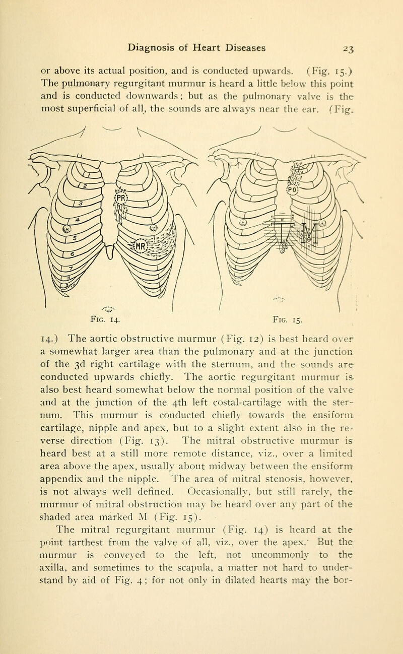 or above its actual position, and is conducted upwards. (y^g. 15.) The pulmonary regurgitant murmur is heard a little below this point and is conducted downwards; but as the pulmonary valve is the most superficial of all, the sounds are always near the ear. (Fig. Fig. 14. Fig. 15. 14.) The aortic obstructive murmur (Fig. 12) is best heard over a somewhat larger area than the pulmonary and at the junction of the 3d right cartilage with the sternum, and the sounds are conducted upwards chiefly. The aortic regurgitant murmur is- also best heard somewhat below the normal position of the valve and at the junction of the 4th left costal-cartilage with the ster- num. This murmur is conducted chiefly towards the ensiform cartilage, nipple and apex, but to a slight extent also in the re- verse direction (Fig. 13). I'he mitral obstructive murmur is heard best at a still more remote distance, viz., over a limited area above the apex, usually about midway between the ensiform- appendix and the nipple. The area of mitral stenosis, however, is not always well defined. Occasionally, but still rarely, the murmur of mitral obstruction may be heard over any part of the shaded area marked M (Fig. 15). The mitral regurgitant murmur (Fig. 14) is heard at the point farthest from the valve of all, viz., over the apex. But the murmur is conveyed to the left, not uncommonly to the axilla, and sometimes to the scapula, a matter not hard to under- stand by aid of Fig. 4; for not only in dilated hearts may the bor-