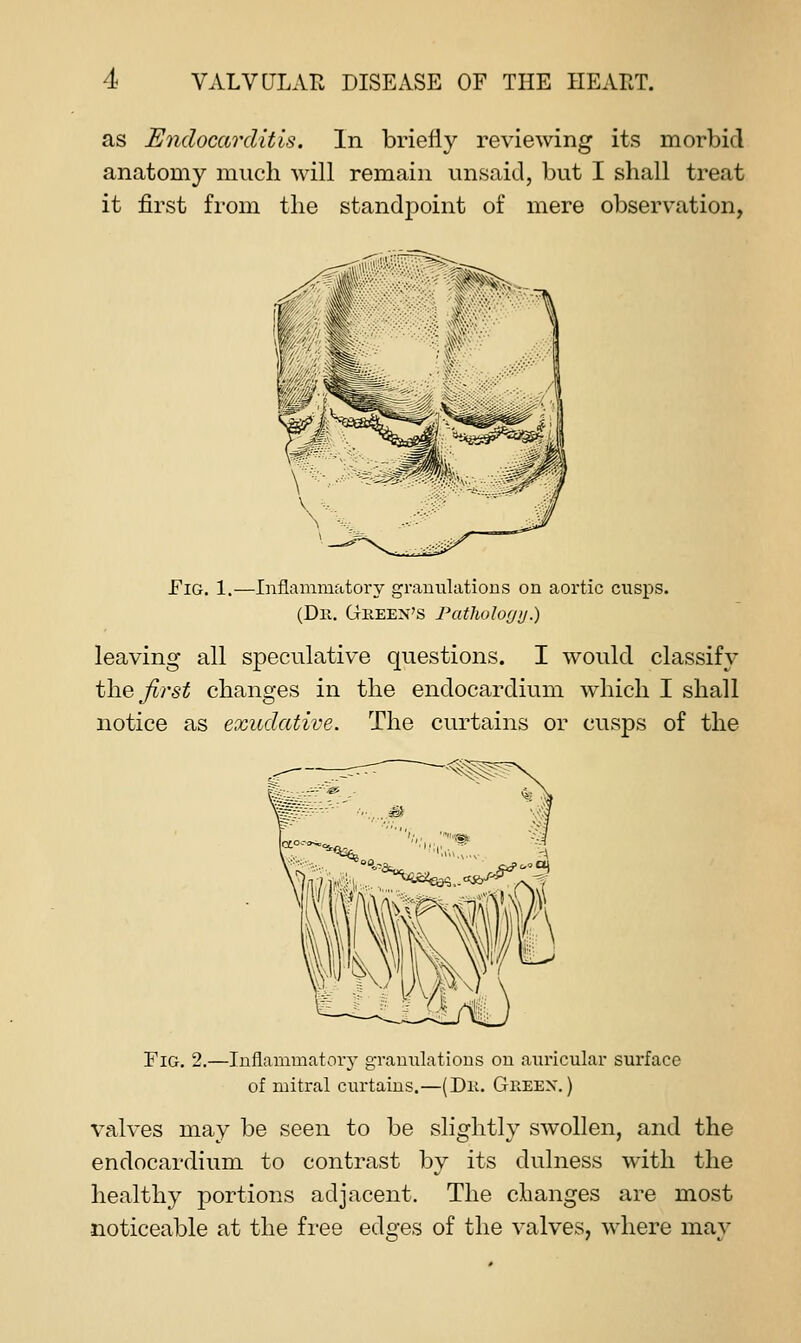 as Endocarditis. In briefly reviewing its morbid anatomy much will remain unsaid, but I shall treat it first from the standpoint of mere observation, Fig. 1.—Inflammatoi-y granulations on aortic cusps. (Dii. Green's Fatlwloyij.) leaving all speculative questions. I would classify th.Q first changes in the endocardium which I shall notice as exudative. The curtains or cusps of the Fig. 2.—Inflammatory granulations on auricular surface of mitral curtains.—(Dii. Greex. ) valves may be seen to be slightly swollen, and the endocardium to contrast by its dulness with the healthy portions adjacent. The changes are most noticeable at the free edges of the valves, where may