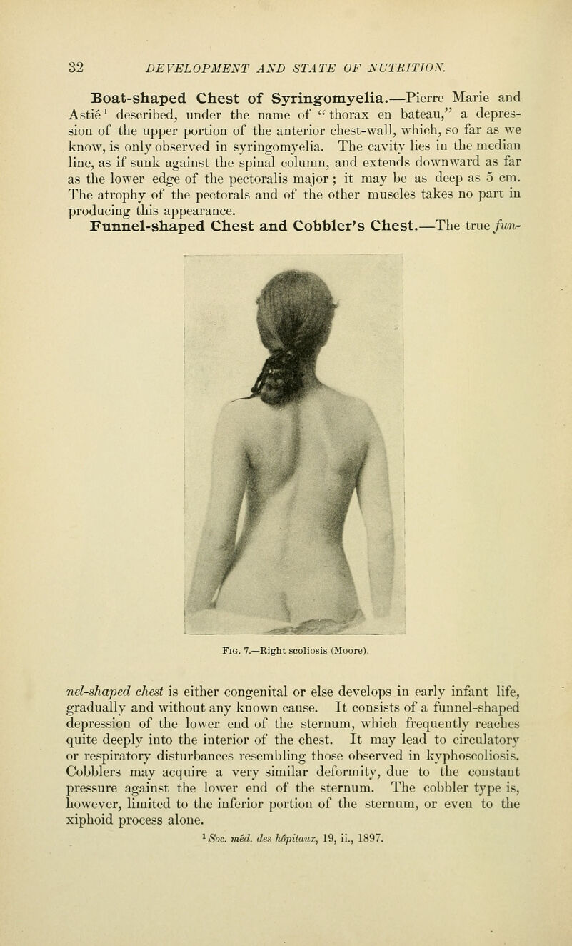 Boat-shaped Chest of Syringomyelia.—Pierre Marie and Asti6 ^ described, under the name of  thorax en bateau, a depres- sion of the upper portion of the anterior chest-wall, which, so far as we know, is only observed in syringomyelia. The cavity lies in the median line, as if sunk against the spinal column, and extends downward as far as the lower edge of the pectoralis major; it may be as deep as 5 cm. The atrophy of the pectorals and of the other muscles takes no part in producing this appearance. Funnel-shaped Chest and Cobbler's Chest.—The true fun- FiG. 7.—Right scoliosis (Moore). nel-shaped chest is either congenital or else develops in early infant life, gradually and without any known cause. It consists of a funnel-shaped depression of the lower end of the sternum, which frequently reaches quite deeply into the interior of the chest. It may lead to circulatory or respiratory disturbances resembling those observed in kyphoscoliosis. Cobblers may acquire a very similar deformity, due to the constant pressure against the lower end of the sternum. The cobbler type is, however, limited to the inferior portion of the sternum, or even to the xiphoid process alone. ^ Soc. mid. des hdpitaux, 19, ii., 1897.