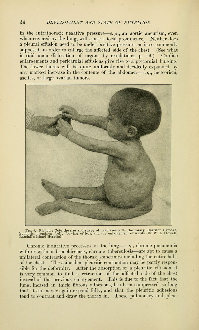 in the intrathoracic negative pressure—e. g., an aortic aneurism, even when covered by the lung, will cause a local prominence. Neither does a pleural effusion need to be under positive pressure, as is so commonly supposed, in order to enlarge the affected side of the <ihest. (See what is said upon dislocation of organs by exudations, p. 79.) Cardiac enlargements and pericardial effusions give rise to a precordial bulging. The lower thorax will be quite uniformly and decidedly expanded by any marked increase in the contents of the abdomen—e. g., meteorism, ascites, or large ovarian tumors. Fig. 9.—Rickets: Note the size and shape of head (see p. 19), the rosary, Harrison's groove, kyphosis, prominent belly, bowing of legs, and the enlargement of wrists (Dr. W. L. Stowell, Randall's Island Hospital). Chronic indurative processes in the lung—e.g., chronic pneumonia with or without bronchiectasis, chronic tuberculosis—are apt to cause a unilateral contraction of the thorax, sometimes including the entire half of the chest. The coincident pleuritic contraction may be partly respon- sible for the deformity. After the absorption of a pleuritic effusion it is very common to find a retraction of the affected side of the chest instead of the previous enlargement. This is due to the fact that the lung, incased in thick fibrous adhesions, has been compressed so long that it can never again expand fully, and that the pleuritic adhesions tend to contract and draw the thorax in. These pulmonary and pleu-