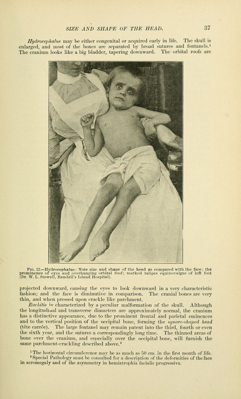 Hydrocephalus may be either congenital or acquired early in life. The skull is enlarged, and most of the bones are separated by broad sutures and fontanels, i The cranium looks like a big bladder, tapering downward. The orbital roofs are Fig. 12.—Hydrocephalus: Note size and shape of the head as compared with the face; the prominence of eyes and overhanging orbital roof; marked talipes equinovalgus of left foot (Dr. W. L.'Stowell, Randall's Island Hospital). projected downward, causing the eyes to look downward in a very characteristic fashion; and the face is diminutive in comparison. The cranial bones are very thin, and when pressed upon crackle like parchment. Rachitis is- characterized by a peculiar malformation of the skull. Although the longitudinal and transverse diameters are approximately normal, the cranium has a distinctive appearance, due to the prominent frontal and parietal eminences and to the vertical position of the occipital bone, forming the square-shaped head (tete carree). The large fontanel may remain patent into the third, fourth or even the sixth year, and the sutures a correspondingly long time. The thinned areas of bone over the cranium, and especially over the occipital bone, will furnish the same parchment-crackling described above.* ^ The horizontal circumference may be as much as .50 cm. in the first month of life. 'Special Pathology must be consulted for a description of the deformities of the face in acromegaly and of the asymmetry in hemiatrophia facialis progressiva.