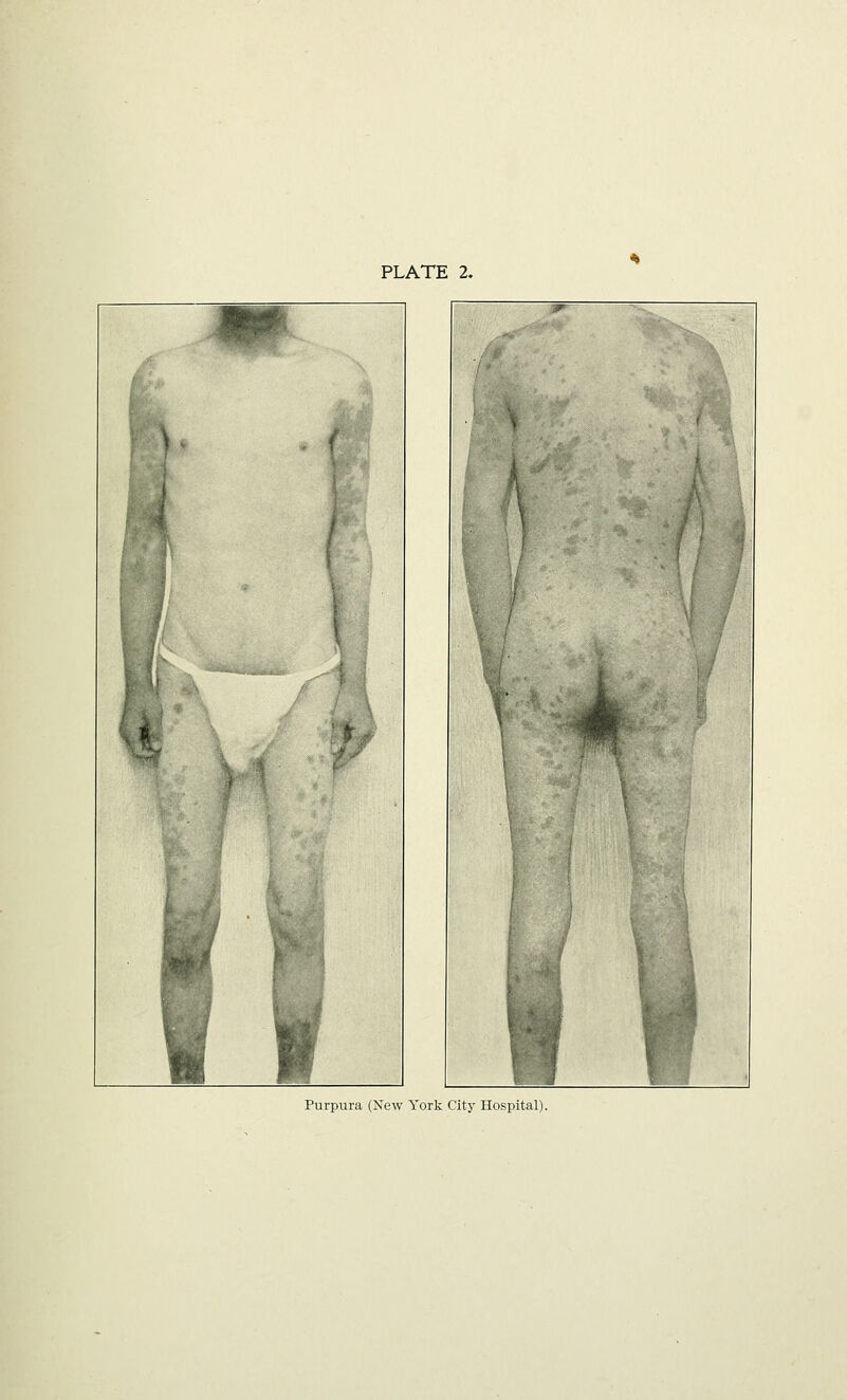 PLATE 2. Purpura (New York City Hospital).