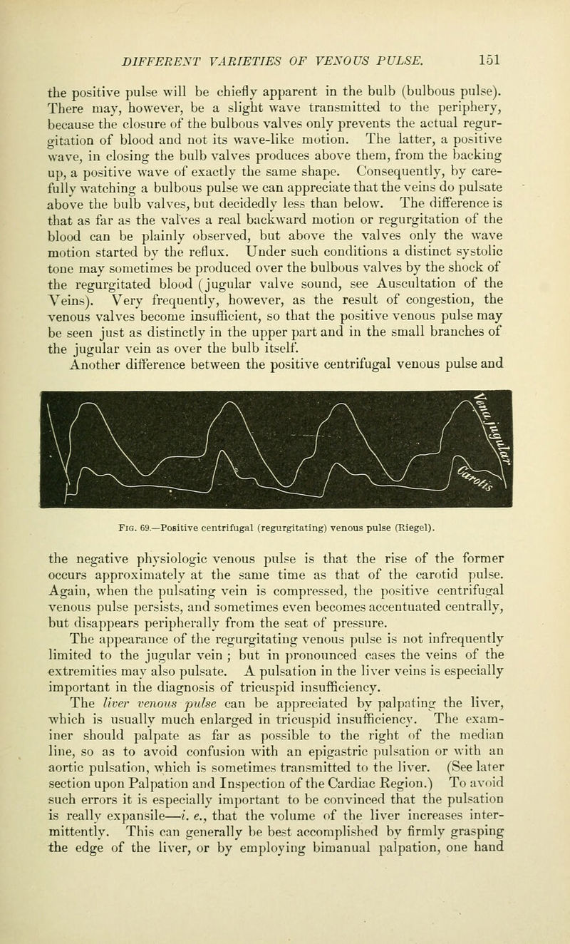 the positive pulse will be chiefly apparent in the bulb (bulbous pulse). There may, however, be a slight wave transmitted to the periphery, because the closure of the bulbous valves only prevents the actual regur- gitation of blood and not its wave-like motion. The latter, a positive wave, in closing the bulb valves produces above them, from the backing up, a positive w^ave of exactly the same shape. Consequently, by care- fullv watching a bulbous pulse we can appreciate that the veins do pulsate above the bulb valves, but decidedly less than below. The difference is that as far as the valves a real backward motion or regurgitation of the blood can be plainly observed, but above the valves only the w^ave motion started by the reflux. Under such conditions a distinct systolic tone may sometimes be produced over the bulbous valves by the shock of the regurgitated blood (jugular valve sound, see Auscultation of the Veins). V^ery frequently, however, as the result of congestion, the venous valves become insufficient, so that the positive venous pulse may be seen just as distinctly in the upper part and in the small branches of the jugular vein as over the bulb itself. Another difference between the positive centrifugal venous pulse and Fig. 69.—Positive centrifugal (regurgitating) venous pulse (Riegel). the negative physiologic venous pulse is that the rise of the former occurs approximately at the same time as that of the carotid pulse. Again, when the pulsating vein is compressed, the positive centrifugal venous pulse persists, and sometimes even becomes accentuated centrally, but disappears peripherally from the seat of pressure. The appearance of the regurgitating venous pulse is not infrequently limited to the jugular vein ; but in ])ronounced cases the veins of the extremities may also pulsate. A pulsation in the liver veins is especially important in the diagnosis of tricuspid insufficiency. The liver venous pulse can be appreciated by palpating the liver, which is usually much enlarged in tricuspid insufficiency. The exam- iner should palpate as far as possible to the right of the median line, so as to avoid confusion with an epigastric pulsation or with an aortic pulsation, which is sometimes transmitted to the liver. (See later section upon Palpation and Inspection of the Cardiac Kegion.) To avoid such errors it is especially important to be convinced that the pulsation is really expansile—{. e., that the volume of the liver increases inter- mittently. This can generally be best accomplished by firmly grasping the edge of the liver, or by employing bimanual palpation, one hand