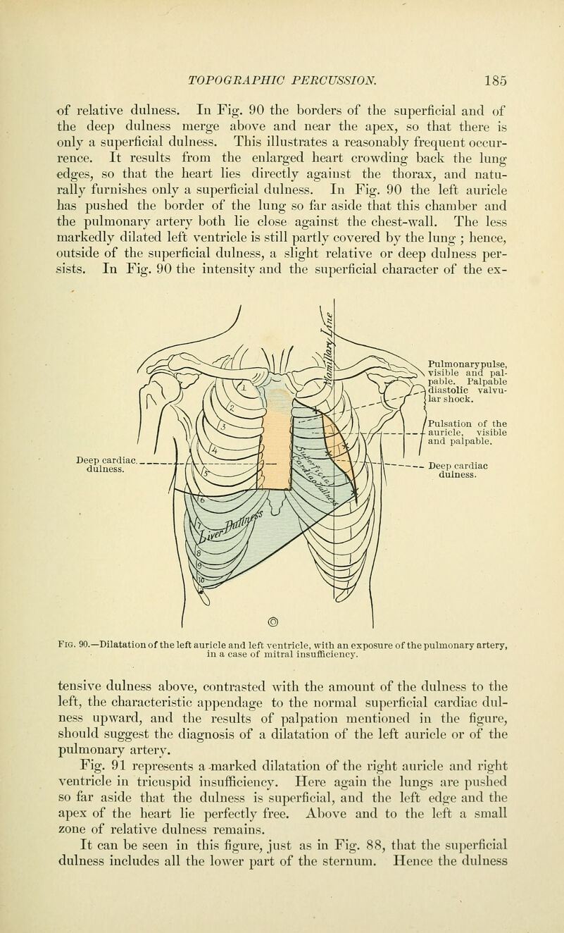 of relative dulness. lu Fig. 90 the borders of the superficial and of the deep dulness merge above and near the apex, so that there is only a superficial dulness. This illustrates a reasonably frequent occur- rence. It results from the enlarged heart crowding back the lung edges, so that the heart lies directly against the thorax, and natu- rally furnishes only a superficial dulness. In Fig. 90 the left auricle has pushed the border of the lung so far aside that this chamber and the pulmonary artery both lie close against the chest-wall. The less markedly dilated left ventricle is still partly covered by the lung ; hence, outside of the superficial dulness, a slight relative or deep dulness per- sists. In Fig. 90 the intensity and the superficial character of the ex- Deep cardiac dulness. Pulmonarypulse, visible and pal- pable. Palpable diastolic valvu- lar shock. Pulsation of the auricle, visible and palpable. Deep cardiac dulness. Fig. 90.—Dilatation of the left auricle and left ventricle, with an exposure of the pulmonary artery, in a case of mitral insuf&ciency. tensive dulness above, contrasted with the amount of the dulness to the left, the characteristic appendage to the normal superficial cardiac dul- ness upward, and the results of palpation mentioned in the figure, should suggest the diagnosis of a dilatation of the left auricle or of the pulmonary artery. Fig. 91 represents a-marked dilatation of the right auricle and right ventricle in tricuspid insufficiency. Here again the lungs are pushed so far aside that the dulness is superficial, and the left edge and the apex of the heart lie perfectly free. Above and to the left a small zone of relative dulness remains. It can be seen in this figure, just as in Fig. 88, that the superficial dulness includes all the lower part of the sternum. Hence the dulness