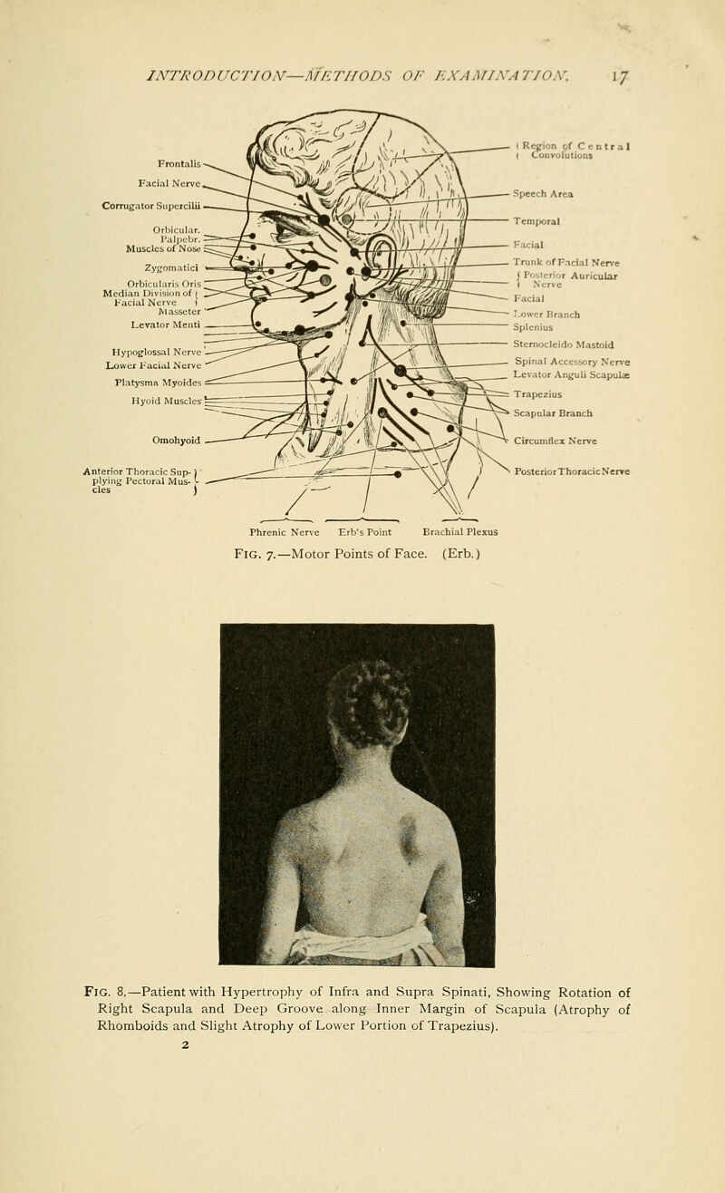 Frontalis Facial Nerve Corrugator Supercilii Orbicular. Palpebr. Muscles of Noso Zygomatici Orbicularis Oris Median Division of 1 Facial Nerve f JVIasseter Levator Menti Hypoglossal Nerve Lower Facial Nerve Platysma Myoides Hyoid Muscles Omohyoid Anterior Thoracic Sup-) plying Pectoral Mus- cles I Phrenic Nerve Erb's Point Brachial Plexus Fig. 7.—Motor Points of Face. (Erb.) I Region of Central ( Convolutions Speech Area Temporal Facial Trunk of Facial Nerve J Posterior Auricular I Nerve Facial Lower FJranch Splenius Sternocleido Mastoid Spinal Accessory Nerve Levator Angult Scapulae Trapezius Scapular Branch Circumflex Nerve PosteriorThoracicNerre Fig. 8.—Patient with Hypertrophy of Infra and Supra Spinati, Showing Rotation of Right Scapula and Deep Groove along Inner Margin of Scapula (Atrophy of Rhomboids and Slight Atrophy of Lower Portion of Trapezius).