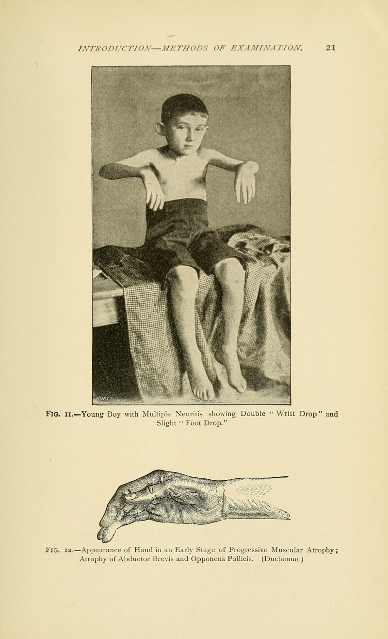 Fig. II.—Young Boy with Multiple Neuritis, showing Double Wrist Drop and Slight  Foot Drop. FlG. 12.—Appearance of Hand in an Early Stage of Progressive Muscular Atrophy; Atrophy of Abductor Brevis and Opponens Pollicis. (Duchenne.)
