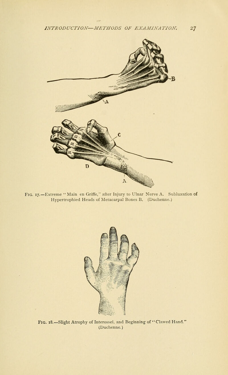 Fig. 17.—Extreme  Main en Griffe, after Injury to Ulnar Nerve A. Subluxation of Hypertrophied Heads of Metacarpal Bones B. (Duchenne.) Fig. 18.—Slight Atrophy of Interossei, and Beginning of Clawed Hand. (Duchenne.)