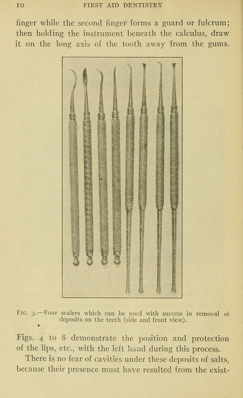 finger while the second finger forms a guard or fulcrum; then holding the instrument beneath the calculus, draw it on the long axis of the tooth away from the gums. Fig. 3.—Four scalers which can be used with success in removal of deposits on the teeth (side and front view). Figs. 4 to 8 demonstrate the position and protection of the lips, etc., with the left hand during this process. There is no fear of cavities under these deposits of salts, because their presence must have resulted from the exist-