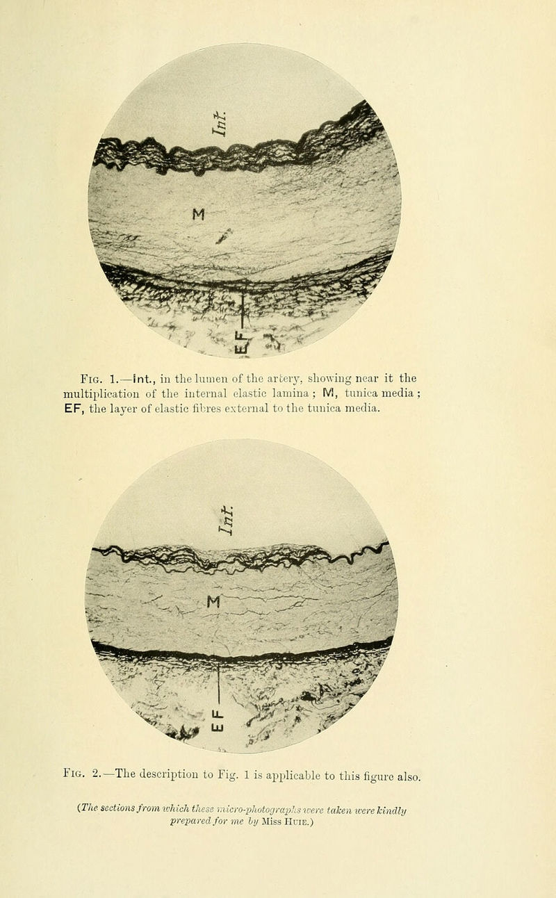 Fig. 1.—Int., in the lumen of the artery, showing near it the multiplication of the internal elastic lamina ; M, tunica media ; EF, the layer of elastic fibres external to the tunica media. Fig. 2.—The description to Fig. 1 is a^Dplicable to this fio-urc also. {The sections from which these micro-photograxilis were taken icere kindly prepared for me It/ Miss Huie.)