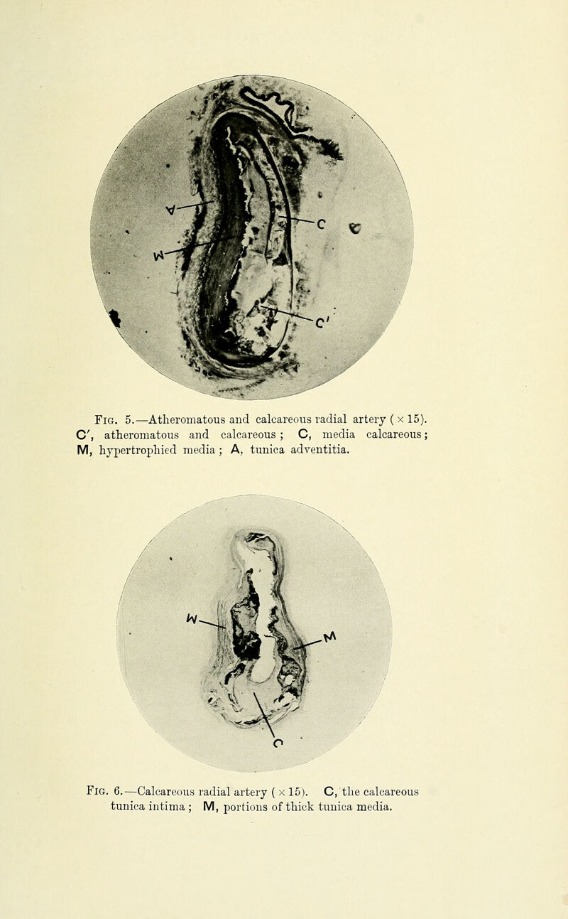 Fig. 5.—Atheromatous and calcareous radial artery ( x 15). C, atheromatous and calcareous ; C, media calcareous; M, hypertrophied media ; A, tunica adventitia. Fig. 6.—Calcareous radial artery ( x 15). C, the calcareous tunica intima; M, portions of thick tunica media.
