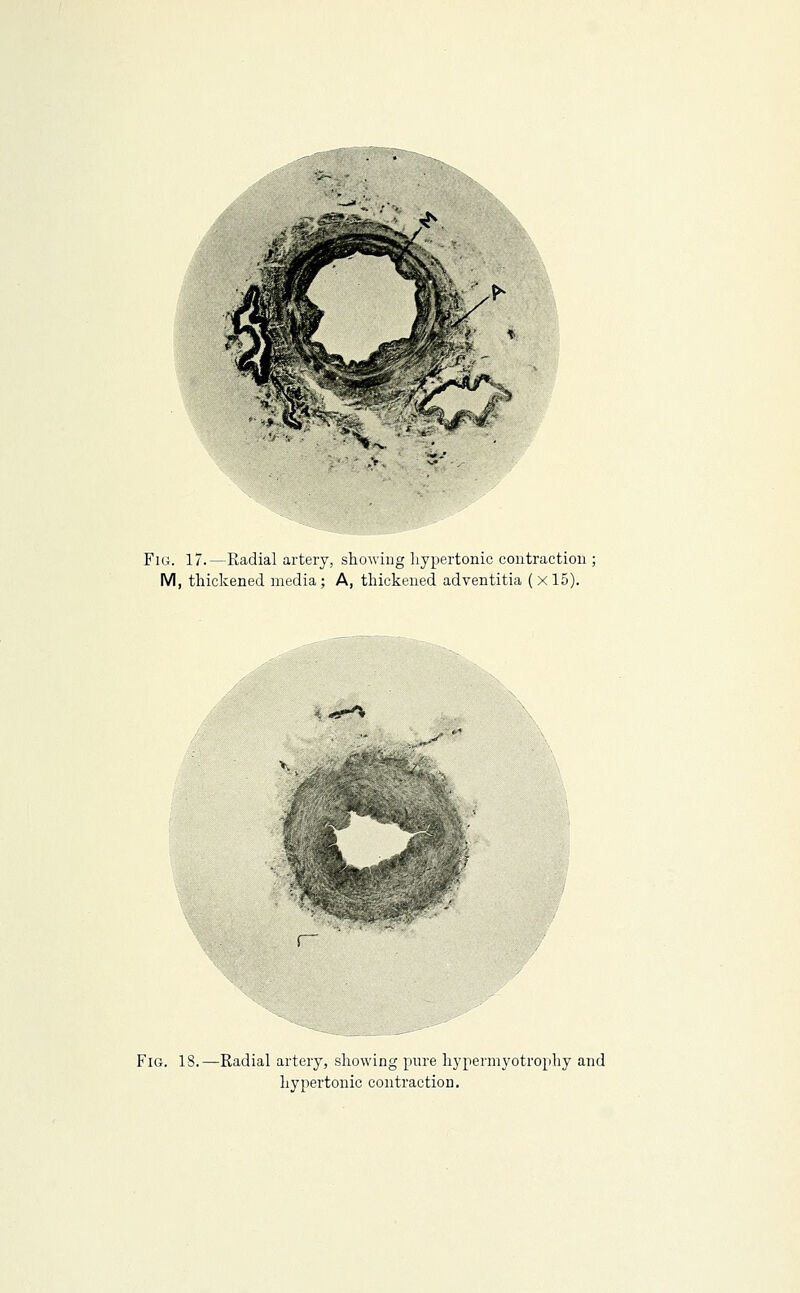 Fig. 17.—Radial artery, showing hypertonic contraction M, thickened media; A, thickened adventitia (xl5). Fig. 18.—Radial artery, showing pure hypermyotro[ihy and hypertonic contraction.