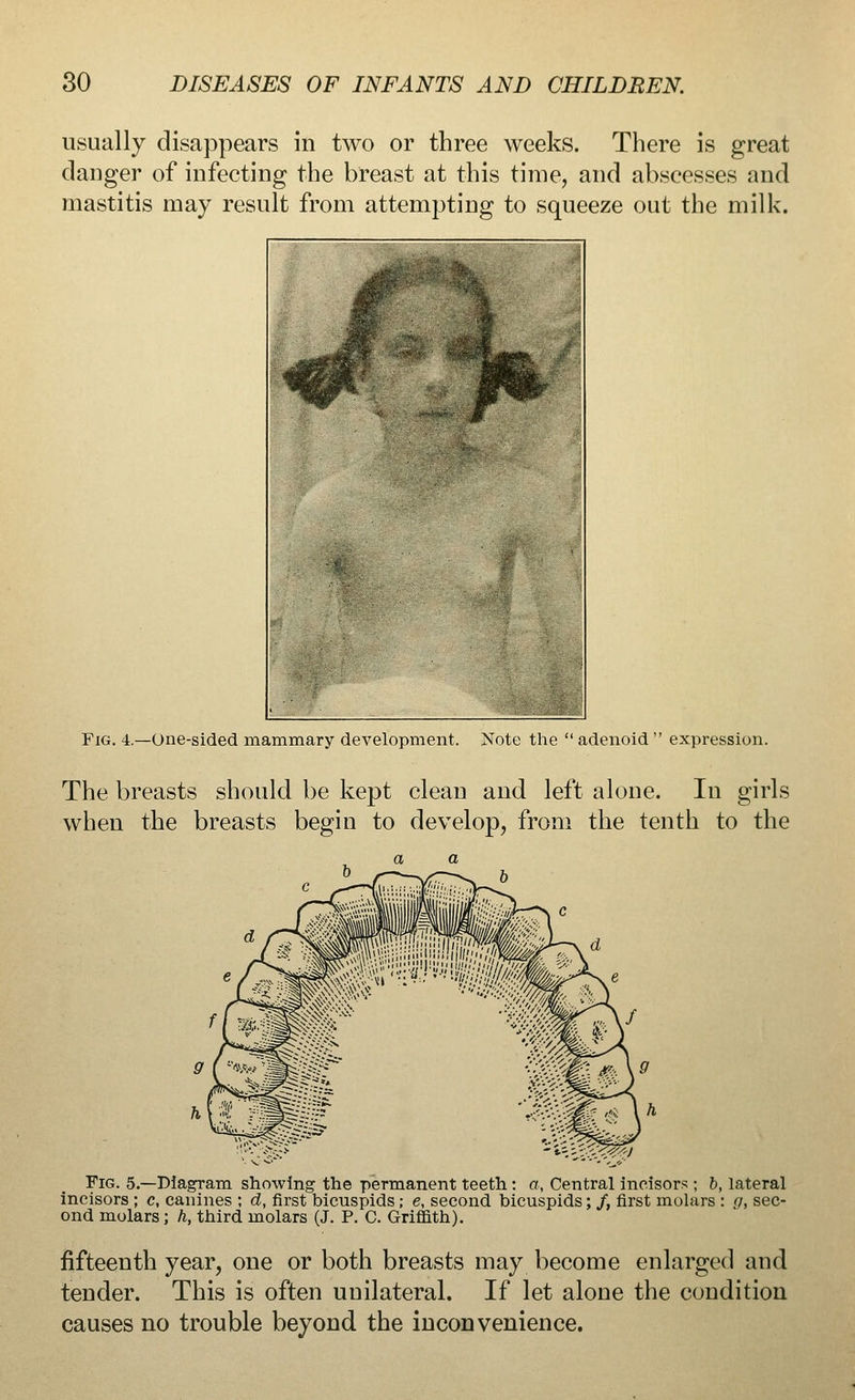 usually disappears in two or three weeks. There is great danger of infecting the breast at this time, and abscesses and mastitis may result from attempting to squeeze out the milk. Fig. 4.—One-sided mammary development. Note the adenoid expression. The breasts should be kept clean and left alone. In girls when the breasts begin to develop, from the tenth to the Fig. 5.—Diagram showing the permanent teeth : a, Central incisors ; b, lateral incisors ; c, canines ; d, first bicuspids; e, second bicuspids; /, first molars : o, sec- ond molars ; h, third molars (J. P. C Griffith). fifteenth year, one or both breasts may become enlarged and tender. This is often unilateral. If let alone the condition causes no trouble beyond the inconvenience.