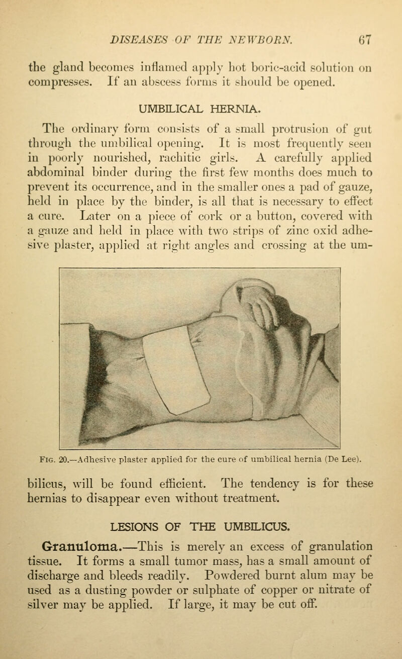 the gland becomes inflamed apply hot boric-acid solution on compresses. If an abscess forms it should be opened. UMBILICAL HERNIA. The ordinary form consists of a small protrusion of gut through the umbilical opening. It is most frequently seen in poorly nourished, rachitic girls. A carefully applied abdominal binder during the first few months does much to prevent its occurrence, and in the smaller ones a pad of gauze, held in place by the binder, is all that is necessary to effect a cure. Later on a piece of cork or a button, covered with a gauze and held in place with two strips of zinc oxid adhe- sive plaster, applied at right angles and crossing at the um- Fig. 20.—Adhesive plaster applied for the cure of umbilical hernia (De Lee). bilicus, will be found efficient. The tendency is for these hernias to disappear even without treatment. LESIONS OF THE UMBILICUS. Granuloma.—This is merely an excess of granulation tissue. It forms a small tumor mass, has a small amount of discharge and bleeds readily. Powdered burnt alum may be used as a dusting powder or sulphate of copper or nitrate of silver may be applied. If large, it may be cut off.